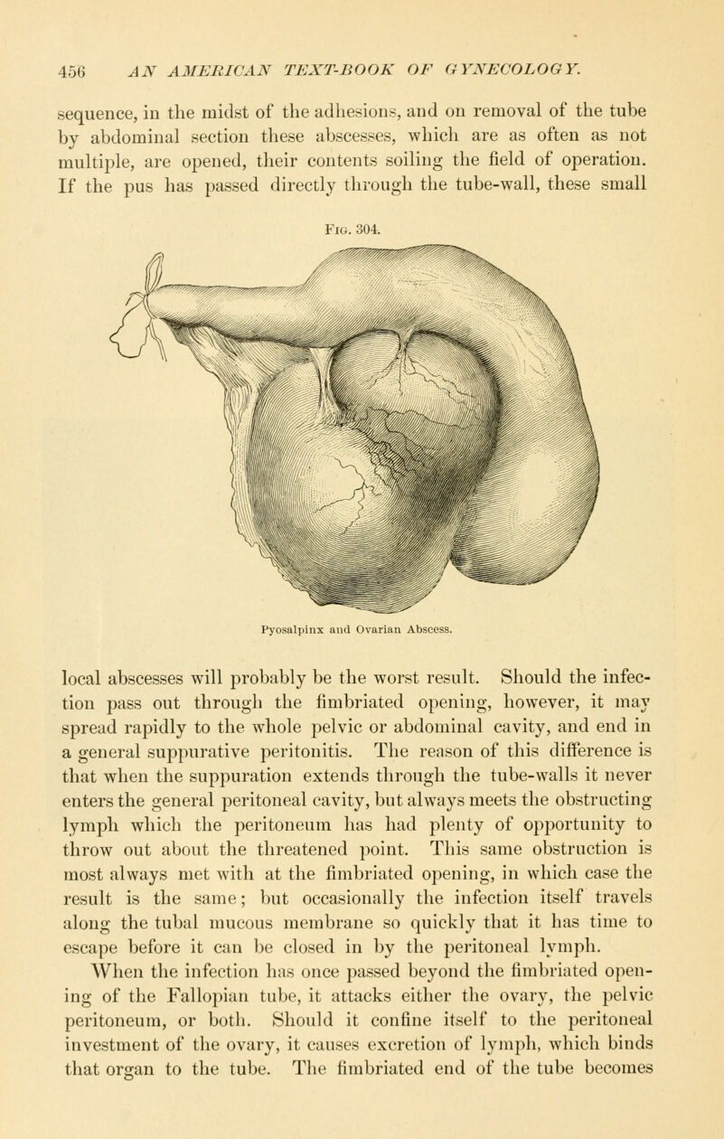 sequence, in the midst of the adhesions, and on removal of the tube by abdominal section these abscesses, which are as often as not multiple, are opened, their contents soiling the field of operation. If the pus has passed directly through the tube-wall, these small Fig. 304. Pyosalpinx and Ovarian Abscess. local abscesses will probably be the worst result. Should the infec- tion pass out through the fimbriated opening, however, it may spread rapidly to the whole pelvic or abdominal cavity, and end in a general suppurative peritonitis. The reason of this difference is that when the suppuration extends through the tube-walls it never enters the general peritoneal cavity, but always meets the obstructing lymph which the peritoneum has had plenty of opportunity to throw out about the threatened point. This same obstruction is most always met with at the fimbriated opening, in which case the result is the same; but occasionally the infection itself travels along the tubal mucous membrane so quickly that it has time to escape before it can be closed in by the peritoneal lymph. When the infection has once passed beyond the fimbriated open- ing of the Fallopian tube, it attacks either the ovary, the pelvic peritoneum, or both. Should it confine itself to the peritoneal investment of the ovary, it causes excretion of lymph, which binds that organ to the tube. The fimbriated end of the tube becomes