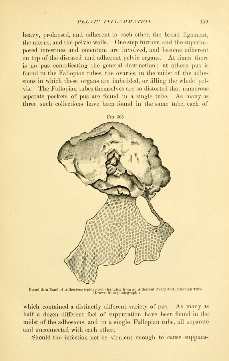 heavy, prolapsed, and adherent to each other, the broad ligament, the uterus, and the pelvic walls. One step further, and the superim- posed intestines and omentum are involved, and become adherent on top of the diseased and adherent pelvic organs. At times there is no pus complicating the general destruction ; at others jius is found in the Fallopian tubes, the ovaries, in the midst of the adhe- sions in which these organs are imbedded, or filling the whole pel- vis. The Fallopian tubes themselves are so distorted that numerous separate pockets of pus are found in a single tube. As many as three such collections have been found in the same tube, each of Fig. 305. Broad thin Band of Adhesions (spider-web) hanging from an Adherent Ovary and Fallopian Tube. (Drawn from photograph.) which contained a distinctly different variety of pus. As many as half a dozen different foci of suppuration have been found in the midst of the adhesions, and in a single Fallopian tube, all separate and unconnected with each other. Should the infection not be virulent enough to cause suppura-