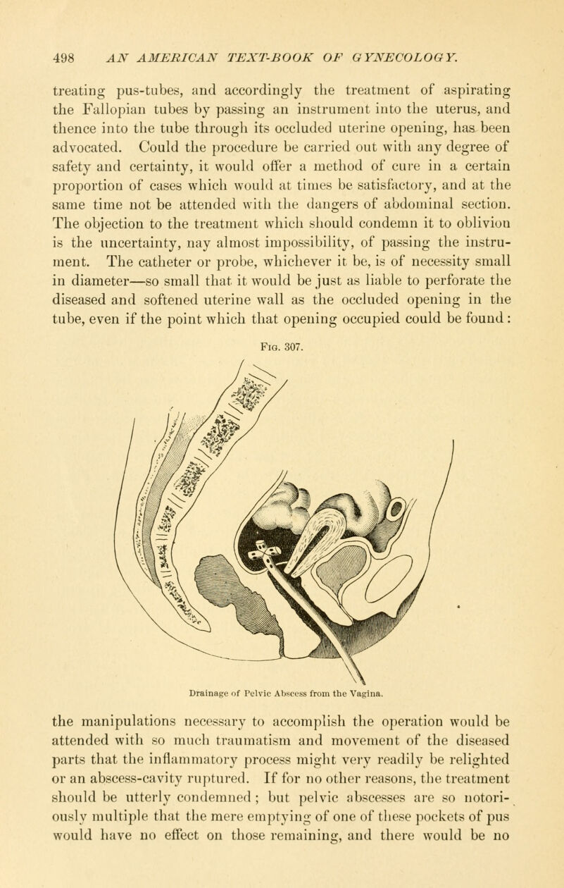 treating pus-tubes, and accordingly the treatment of aspirating the Fallopian tubes by passing an instrument into the uterus, and thence into the tube through its occluded uterine opening, has been advocated. Could the procedure be carried out with any degree of safety and certainty, it would offer a method of cure in a certain proportion of cases which would at times be satisfactory, and at the same time not be attended with the dangers of abdominal section. The objection to the treatment which should condemn it to oblivion is the uncertainty, nay almost impossibility, of j^assing the instru- ment. The catheter or probe, whichever it be, is of necessity small in diameter—so small that it would be just as liable to perforate the diseased and softened uterine wall as the occluded opening in the tube, even if the point which that opening occupied could be found: Fig. 307. Drainage of Pelvic Abscess from the Vagina. the manipulations necessary to accomplish the operation would be attended with so much traumatism and movement of the diseased parts that the inflammatory process might very readily be relighted or an abscess-cavity ruptured. If for no other reasons, the treatment should be utterly condemned ; but pelvic abscesses are so notori- ously multiple that the mere emptying of one of these pockets of pus would have no effect on those remaininsr, and there would be no