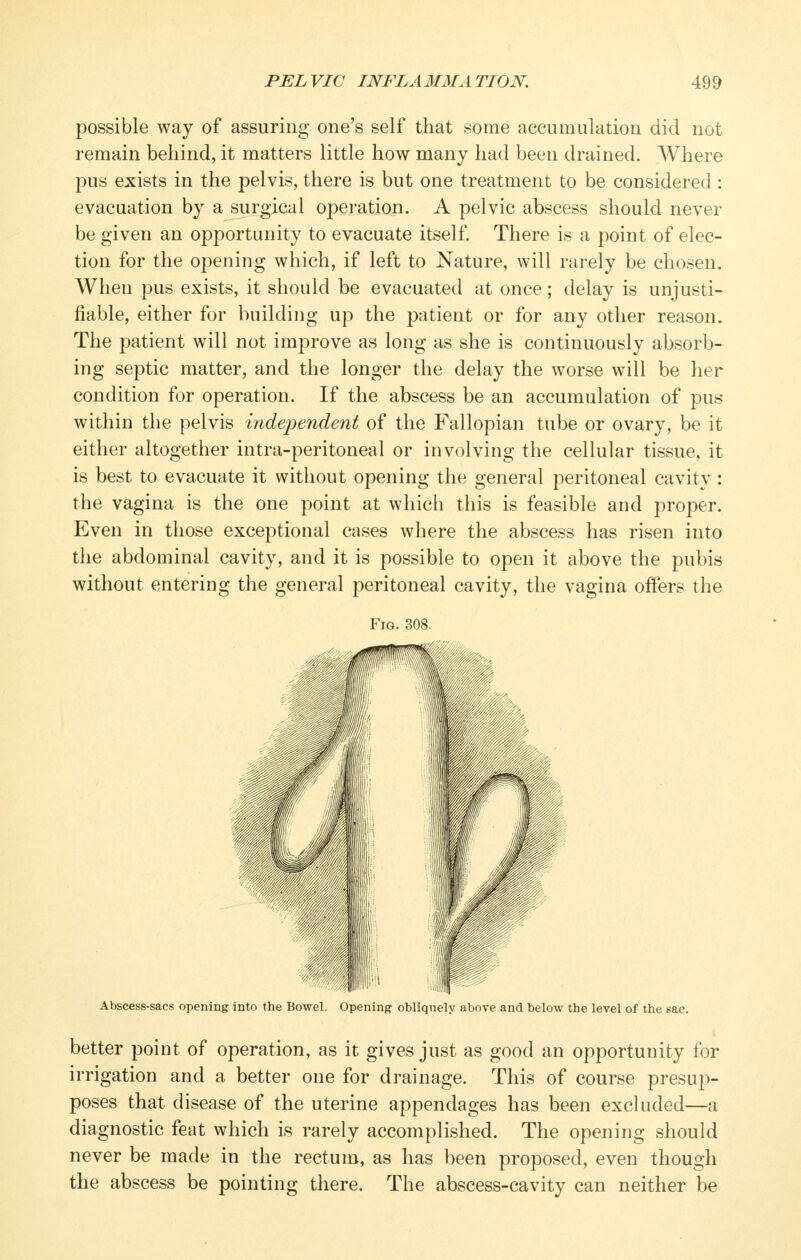 possible way of assuring one's self that some accumulation did not remain behind, it matters little how many had been drained. Where pus exists in the pelvis, there is but one treatment to be considered : evacuation by a surgical operation. A pelvic abscess should never be given an opportunity to evacuate itself. There is a point of elec- tion for the opening which, if left to Nature, will rarely be chosen. When pus exists, it should be evacuated at once; delay is unjusti- fiable, either for building up the patient or for any other reason. The patient will not improve as long as she is continuously absorb- ing septic matter, and the longer the delay the worse will be her condition for operation. If the abscess be an accumulation of pus within the pelvis independent of the Fallopian tube or ovary, be it either altogether intra-peritoneal or involving the cellular tissue, it is best to evacuate it without opening the general peritoneal cavity: the vagina is the one point at which this is feasible and proper. Even in those exceptional cases where the abscess has risen into the abdominal cavity, and it is possible to open it above the pubis without entering the general peritoneal cavity, the vagina offers the Fig. 308. Abscess-sacs opening into the Bowel. Opening obliquely above and below the level of the sac. better point of operation, as it gives just as good an opportunity for irrigation and a better one for drainage. This of course presup- poses that disease of the uterine appendages has been excluded—a diagnostic feat which is rarely accomplished. The opening should never be made in the rectum, as has been proposed, even though the abscess be pointing there. The abscess-cavity can neither be