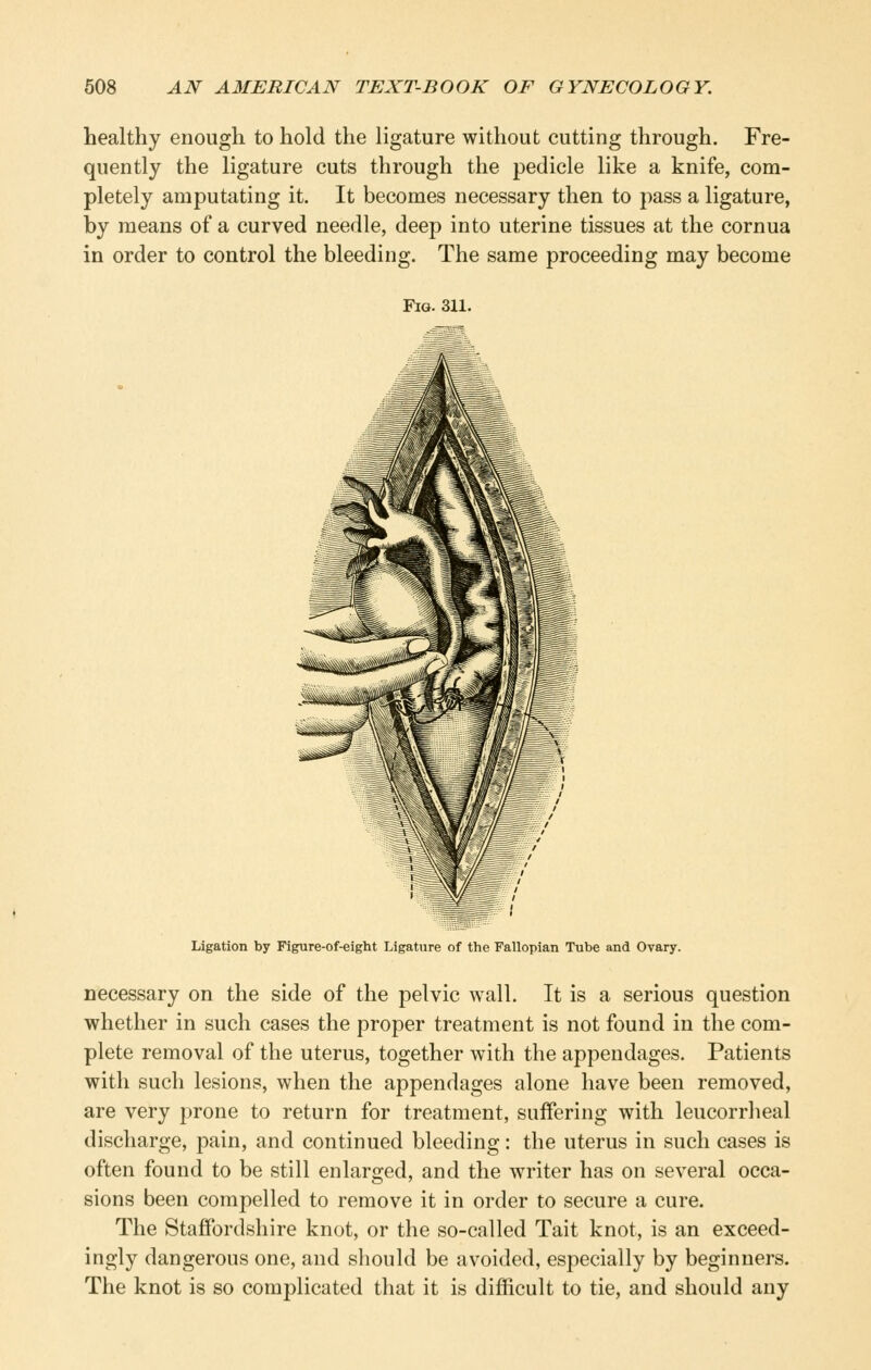 healthy enough to hold the ligature without cutting through. Fre- quently the ligature cuts through the pedicle like a knife, com- pletely amputating it. It becomes necessary then to pass a ligature, by means of a curved needle, deep into uterine tissues at the cornua in order to control the bleeding. The same proceeding may become Fig. 311. Ligation by Figure-of-eight Ligature of the Fallopian Tube and Ovary. necessary on the side of the pelvic wall. It is a serious question whether in such cases the proper treatment is not found in the com- plete removal of the uterus, together with the appendages. Patients with such lesions, when the appendages alone have been removed, are very prone to return for treatment, suffering with leucorrheal discharge, pain, and continued bleeding: the uterus in such cases is often found to be still enlarged, and the writer has on several occa- sions been compelled to remove it in order to secure a cure. The Staffordshire knot, or the so-called Tait knot, is an exceed- ingly dangerous one, and should be avoided, especially by beginners. The knot is so complicated that it is difficult to tie, and should any