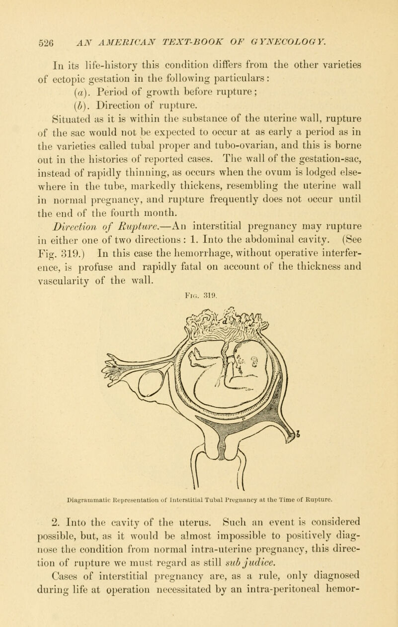 In its life-history this condition differs from the other varieties of ectopic gestation in the following particulars: (a). Period of growth before rupture; {b). Direction of rupture. Situated as it is within the substance of the uterine wall, rupture of the sac would not be expected to occur at as early a period as in the varieties called tubal proper and tubo-ovarian, and this is borne out in the histories of reported cases, Tlie wall of the gestation-sac, instead of rapidly thinning, as occurs when the ovum is lodged else- where in the tube, markedly thickens, resembling the uterine wall in normal pregnancy, and rupture frequently does not occur until the end of the fourth month. Direction of Rupture.—An interstitial pregnancy may rupture in either one of two directions : 1. Into the abdominal cavity. (See Fig. 319.) In this case the hemorrhage, without operative interfer- ence, is profuse and rapidly fatal on account of the thickness and vascularity of the wall. Fig. 319. Diagrammatic Representation of Interstitial Tubal Pregnancy at tlie Time of Rupture 2. Into the cavity of the uterus. Such an event is considered possible, but, as it would be almost impossible to positively diag- nose the condition from normal intra-uterine pregnancy, this direc- tion of rupture we must regard as still sub judice. Cases of interstitial pregnancy are, as a rule, only diagnosed during life at operation necessitated by an intra-peritoneal hemor-