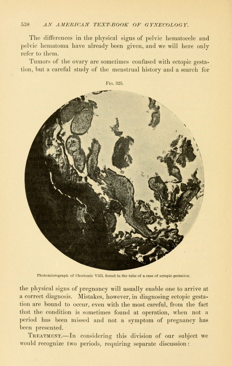 The differences in the physical signs of pelvic hematocele and pelvic hematoma have already been given, and we will here only refer to them. Tumors of the ovary are sometimes confused with ectopic gesta- tion, but a careful study of the menstrual history and a search for Fig. 325. Photomicrograph of Chorionic Villi, found in the tube of a case of ectopic gestation. the physical signs of pregnancy will usually enable one to arrive at a correct diagnosis. Mistakes, however, in diagnosing ectopic gesta- tion are bound to occur, even with the most careful, from the fact that the condition is sometimes found at operation, when not a period has been missed and not a symptom of pregnancy has been presented. Treatment.—In considering this division of our subject we would recognize two periods, requiring separate discussion :