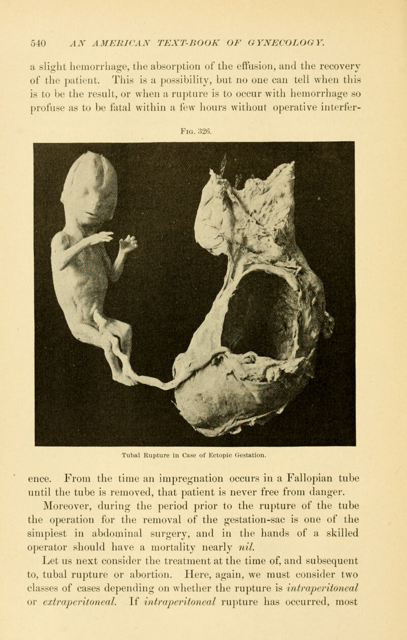 a slight hemorrhage, the absorption of the effusion, and the recovery of the patient. This is a possibility, but no one can tell when this is to be the result, or when a rupture is to occur with hemorrhage so profuse as to be fatal within a few hours without operative interfer- FiG. 326. Tubal Rupture in Case of Ectopic Gestation. ence. From the time an impregnation occurs in a Fallopian tube until the tube is removed, that patient is never free from danger. Moreover, during the period prior to the rupture of the tube the operation for the removal of the gestation-sac is one of the simplest in abdominal surgery, and in the hands of a skilled operator should have a mortality nearly 7iiL Let us next consider the treatment at the time of, and subsequent to, tubal rupture or abortion. Here, again, we must consider two classes of cases depending on whether the rupture is intraperitoneal or extraperitoneal. If intraperitoneal ru})ture has occurred, most