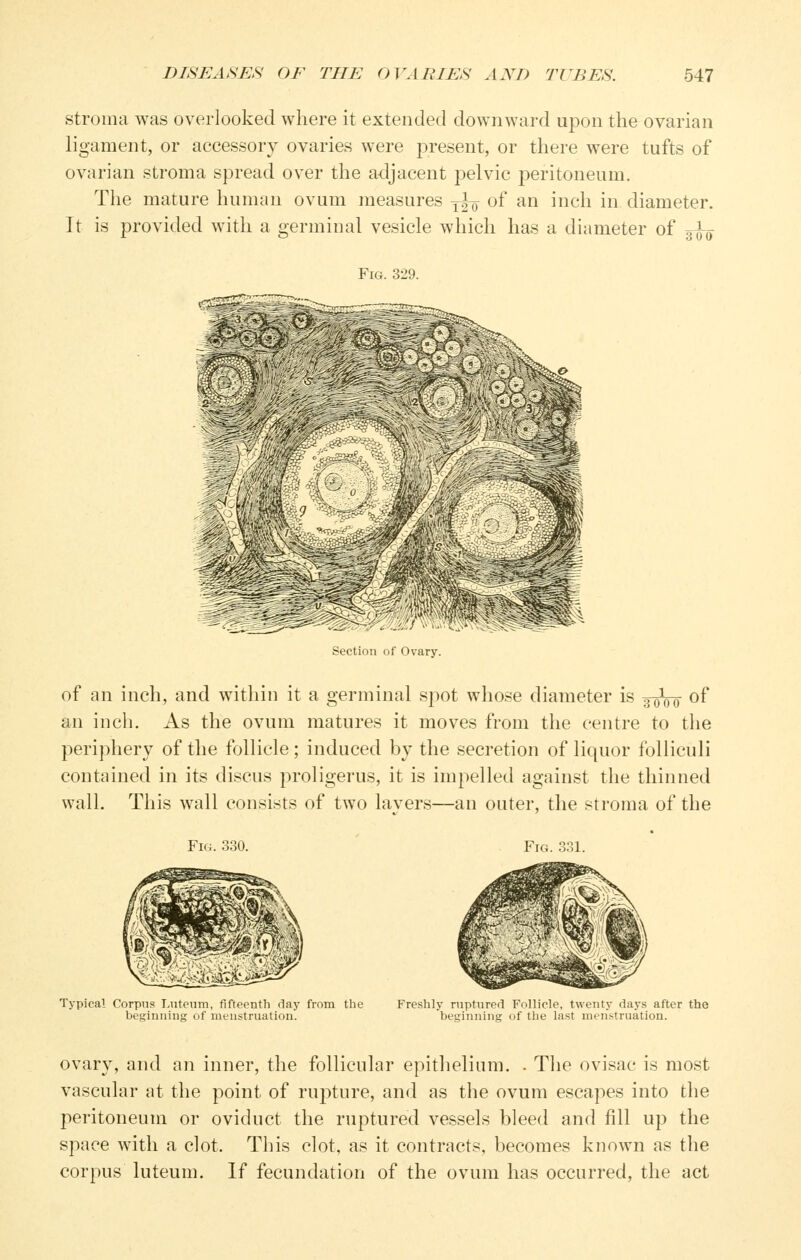 stroma was overlooked where it extended downward upon the ovarian ligament, or accessory ovaries were present, or there were tufts of ovarian stroma spread over the adjacent pelvic peritoneum. The mature human ovum measures j^ of an inch in diameter. It is provided with a germinal vesicle which has a diameter of 3^^ Fig. 329. Section of Ovary. of an inch, and within it a germinal spot whose diameter is 3^0 of an inch. As the ovum matures it moves from the centre to the periphery of the follicle; induced by the secretion of liquor folliculi contained in its discus proligerus, it is impelled against the thinned wall. This wall consists of two lavers—an outer, the stroma of the Fio. ;^;;i. Typical Corpus Luieuiu, fifteenth day from the beginning of menstruation. Freshly rtiptured tollicle, twenty days after the beginning of the last menstruation. ovary, and an inner, the follicular epithelium. . The ovisac is most vascular at the point of rupture, and as the ovum escapes into the peritoneum or oviduct the ruptured vessels bleed and fill up the space with a clot. This clot, as it contracts, becomes known as the corpus luteum. If fecundation of the ovum has occurred, the act