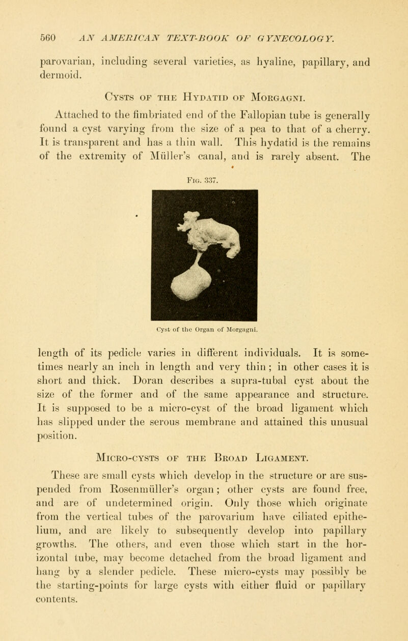 parovarian, including several varieties, as hyaline, papillary, and dermoid. Cysts of the Hydatid of Morgagni. Attached to the fimbriated end of the Fallopian tube is generally found a cyst varying from the size of a pea to that of a cherry. It is transparent and has a tliin wall. This hydatid is the remains of the extremity of Miiller's canal, and is rarely absent. The Fig. 337. Cyst of the Organ of Morgagni length of its pedicle varies in different individuals. It is some- times nearly an inch in length and very thin ; in other cases it is short and thick. Doran describes a supra-tubal cyst about the size of the former and of the same appearance and structure. It is supposed to be a micro-cyst of the broad ligament which has slipped under the serous membrane and attained this unusual position. Micro-cysts of the Broad Ligament. These are smnll cysts which develop in the structure or are sus- pended from Kosenmiiller's organ; other cysts are found free, and are of undetermined origin. Only those which originate from the vertical tubes of the parovarium have ciliated epithe- lium, and are likely to subsequently develop into papillary growths. The others, and even those which start in the hor- izontal tube, may become detached from the broad ligament and hang by a slender pedicle. These micro-cysts may possilily be the starting-points for large cysts with either fluid or papillary contents.