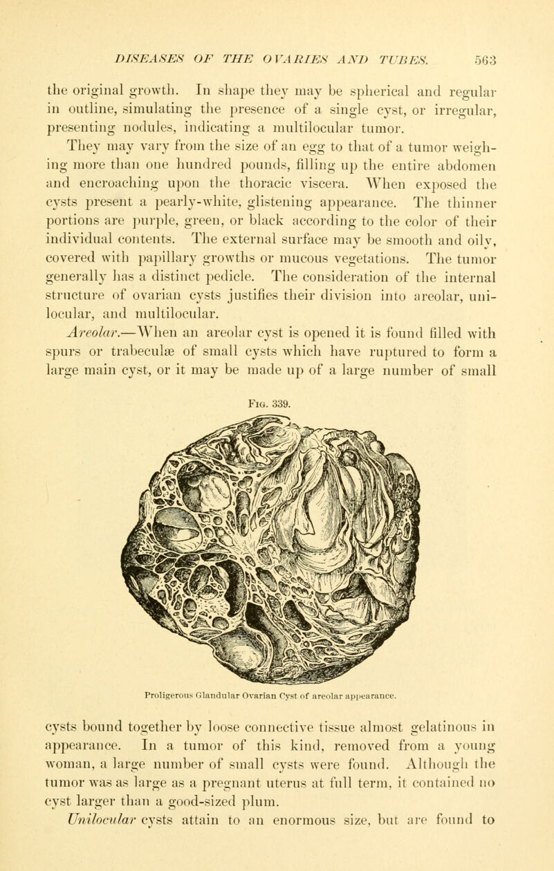 tlie original growth. In shape the}- may be spherical and regular in outline, simulating the presence of a single cyst, or irregular, presenting nodules, indicating a multilocular tumor, Thev may vary from the size of an eo-o- to that of a tumor weish- ing more than one hundred pounds, filling up the entire abdomen and encroaching upon the thoracic viscera. When exposed the cysts present a pearly-white, glistening appearance. The thinner portions are purple, green, or black according to the color of their individual contents. The external surface may be smooth and oily, covered with papillary growths or mucous vegetations. The tumor generally Jias a distinct pedicle. The consideration of the internal structure of ovarian cysts justifies their division into areolar, uni- locular, and multilocular. Alveolar.—When an areolar cyst is opened it is found filled with spurs or trabeculse of small cysts which have ruptured to form a large main cyst, or it may be made up of a large number of small Fig. 339. Proligerous Glandular Ovarian Cyst of areolar appearance. cysts bound together by loose connective tissue almost gelatinous in appearance. In a tumor of this kind, removed from a young woman, a large number of small cysts were found. Although the tumor w^as as large as a pregnant uterus at full term, it contained no cyst larger than a good-sized plum. Unilocular evsts attain to an enormous size, but are found to