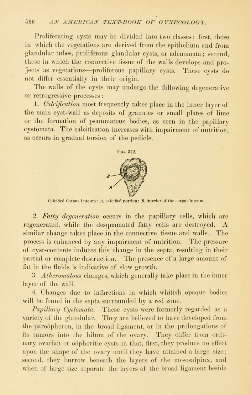 Proliferating cysts may be divided into two classes: first, those in which the vegetations are derived from the epithelium and from glandular tubes, proliferous glandular cysts, or adenomata; second, those in which the connective tissue of the walls develops and pro- jects as vegetations—proliferous papillary cysts. These cysts do not differ essentially in their origin. The walls of the cysts may undergo the following degenerative or retrogressive processes: 1. Calcification most frequently takes place in the inner layer of the main cyst-wall as deposits of granules or small plates of lime or the formation of psammatous bodies, as seen in the papillary cystomata. The calcification increases with impairment of nutrition, as occurs in gradual torsion of the pedicle. Fig. 342. Calcified Corpus Luteum : A, calcified portion; B, interior of the corpus luteum. 2. Fatty degeneration occurs in the papillary cells, which are regenerated, while the desquamated fatty cells are destroyed. A similar change takes place in the connective tissue and walls. The process is enhanced by any impairment of nutrition. The pressure of cyst-contents induces this change in the septa, resulting in their partial or complete destruction. The presence of a large amount of fat in the fluids is indicative of slow growth. 3. Atheromatous changes, which generally take place in the inner layer of the wall. 4. Changes due to infarctions in which whitish opaque bodies will be found in the septa surrounded by a red zone. Papillary Cydomata.—These cysts were formerly regarded as a variety of the glandular. They are believed to have developed from the paroophoron, in the broad ligament, or in the prolongations of its tumoi's into the hilum of the ovary. They differ from ordi- nary ovarian or oophoritic cysts in that, first, they produce no eflfeet upon the shape of the ovary until they have attained a large size; second, they burrow beneath the layers of the mesosalpinx, and when of large size separate the layers of the broad ligament beside