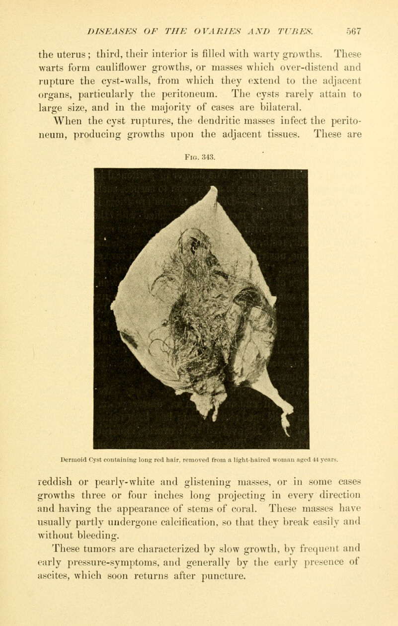 the uterus ; third, their interior is filled with warty growths. These warts form cauliflower growths, or masses which over-distend and rupture the cyst-walls, from which they extend to the adjacent organs, particularly the peritoneum. The cysts rarely attain to large size, and in the majority of cases are bilateral. When the cyst ruptures, the dendritic masses infect the perito- neum, producing growths upon the adjacent tissues. These are Fig. 343. Dermoid Cyst containing long red hair, removed from a light-haired woman aged 44 years. reddish or pearl}-white and glistening masses, or in some cases growths three or four inches long projecting in every direction and having the appearance of stems of coral. These masses have usually partly undergone calcification, so that they break easily and without bleeding. These tumors are characterized by slow growth, by frequent and early pressure-symptoms, and generally by the early presence of ascites, which soon returns after puncture.