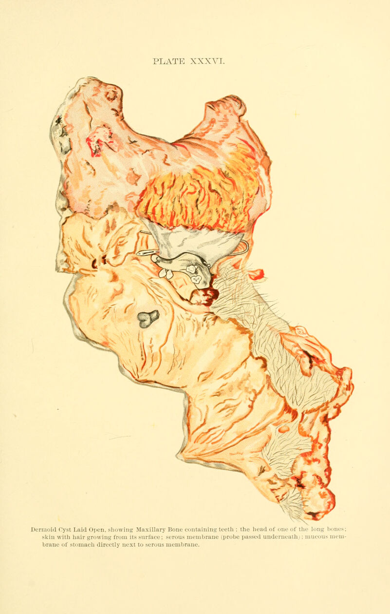 PLATE XXXVI. mmk Derinoid Cyst Laid Open, showing Maxillary Bone coiitaiiiiiiir teetli the lioad ol oik ot thi Imig boni.-- skin with hair growing from its surface; serous membrane (probe parsed undeintaili mu(.ou> uu m- brane of stomach directly next to serous membrane.