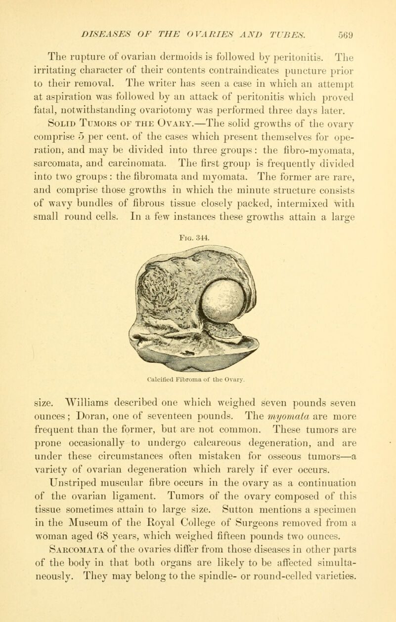 The rupture of ovarian dermoids is followed by peritonitis. The irritating character of their contents contraindicates puncture prior to their removal. The writer has seen a case in which an attempt at aspiration was followed by an attack of peritonitis which proved fatal, notwithstanding ovariotomy was performed three days later. Solid Tumoks of the Ovary.—The solid grow^ths of the ovary comprise 5 per cent, of the cases which present themselves for ope- ration, and may be divided into three groujDS: the fibro-myomata, sarcomata, and carcinomata. The first group is frequently divided into two groups: the fibromata and myomata. The former are rare, and comprise those growths in which the minute structure consists of wavy bundles of fibrous tissue closely packed, intermixed with small round cells. In a few instances these growths attain a large Fig. 344. Calcified Fibroma of the Ovary. size. Williams described one w^iich weighed seven pounds seven ounces; Doran, one of seventeen pounds. The myomata are more frequent than the former, but are not common. These tumors are prone occasionally to undergo calcareous degeneration, and are under these circumstances often mistaken for osseous tumors—a variety of ovarian degeneration which rarely if ever occurs. Unstriped muscular fibre occurs in the ovary as a continuation of the ovarian ligament. Tumors of the ovary composed of this tissue sometimes attain to large size. Sutton mentions a specimen in the Museum of the Royal College of Surgeons removed from a woman aged 68 years, which weighed fifteen pounds two ounces. Sarcomata of the ovaries differ from those diseases in other parts of the body in that both organs are likely to be affected simulta- neously. They may belong to the spindle- or round-celled varieties.