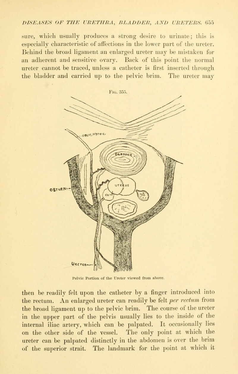 sure, which usually produces a strong desire to urinate; this is especially characteristic of affections in the lower part of the ureter. Behind the broad ligament an enlarged ureter may be mistaken for an adherent and sensitive ovary. Back of this point the normal ureter cannot be traced, unless a catheter is first inserted through the bladder and carried up to the pelvic brim. The ureter may Fig. 355. OSTVJR Pelvic Portion of the Ureter viewed from above. then be readily felt upon the catheter by a finger introduced into the rectum. An enlarged ureter can readily be felt per rectum from the broad ligament up to the pelvic brim. The course of the ureter in the upper part of the pelvis usually lies to the inside of the internal iliac artery, which can be palpated. It occasionally lies on the other side of the vessel. The only point at which the ureter can be palpated distinctly in the abdomen is over the brim of the superior strait. The landmark for the point at which it