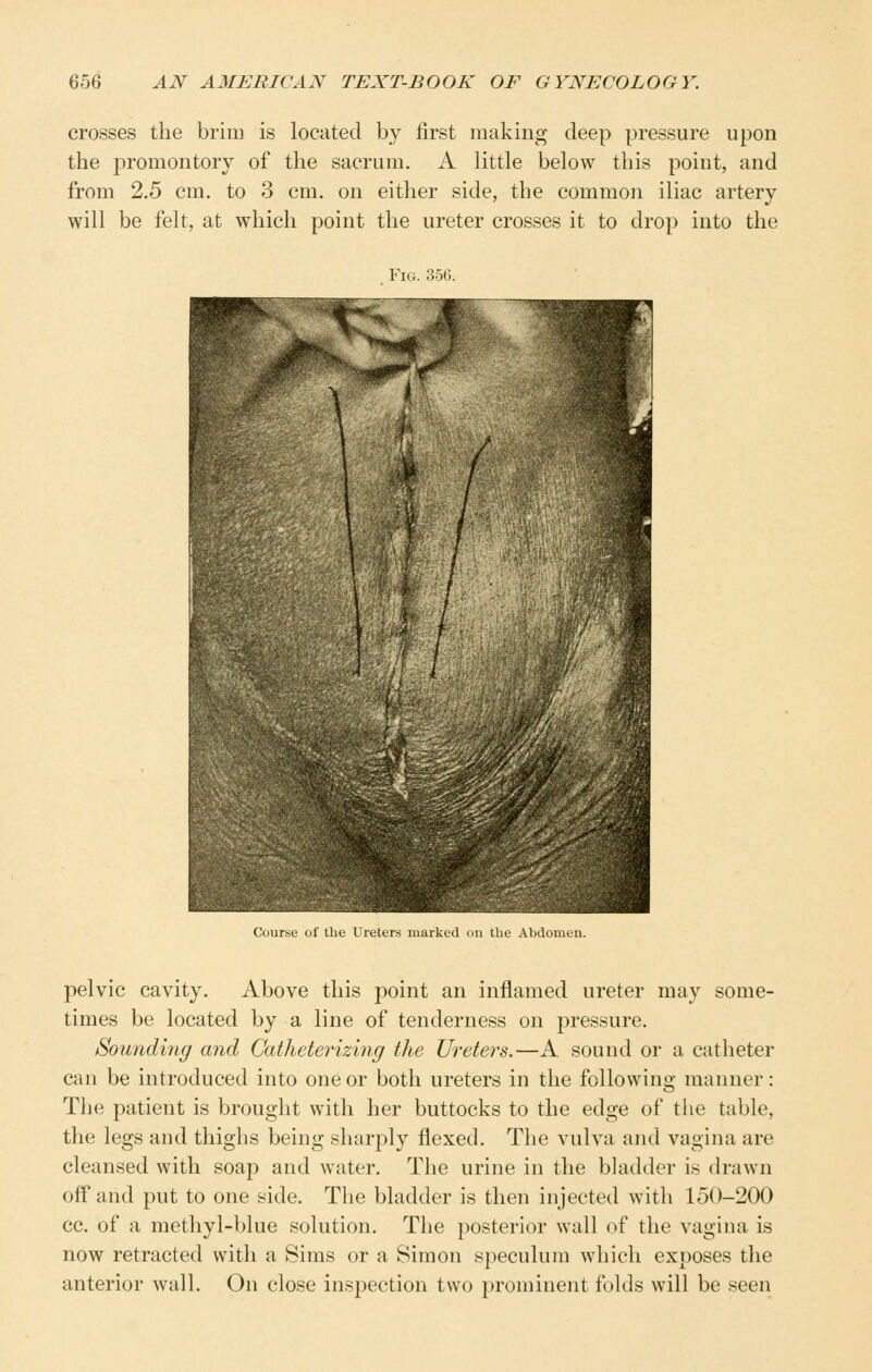 crosses the brim is located by first making deep pressure upon the promontory of the sacrum. A little below this point, and from 2.5 cm. to 3 cm. on either side, the common iliac artery will be felt, at which point the ureter crosses it to drop into the Course of the Ureters marked on the Abdomen. jielvic cavity. Above this point an inflamed ureter may some- times be located by a line of tenderness on pressure. Sounding and Gatheterizing the Ureters.—A sound or a catheter can be introduced into one or both ureters in the following manner: The patient is brought with her buttocks to the edge of the table, the legs and thighs being sharply flexed. The vulva and vagina are cleansed with soap and water. The urine in the bladder is drawn off and put to one side. The bladder is then injected with 150-200 cc. of a methyl-blue solution. The posterior wall of the vagina is now retracted with a Bims or a Simon speculum which exposes the anterior wall. On close inspection two prominent folds will be seen