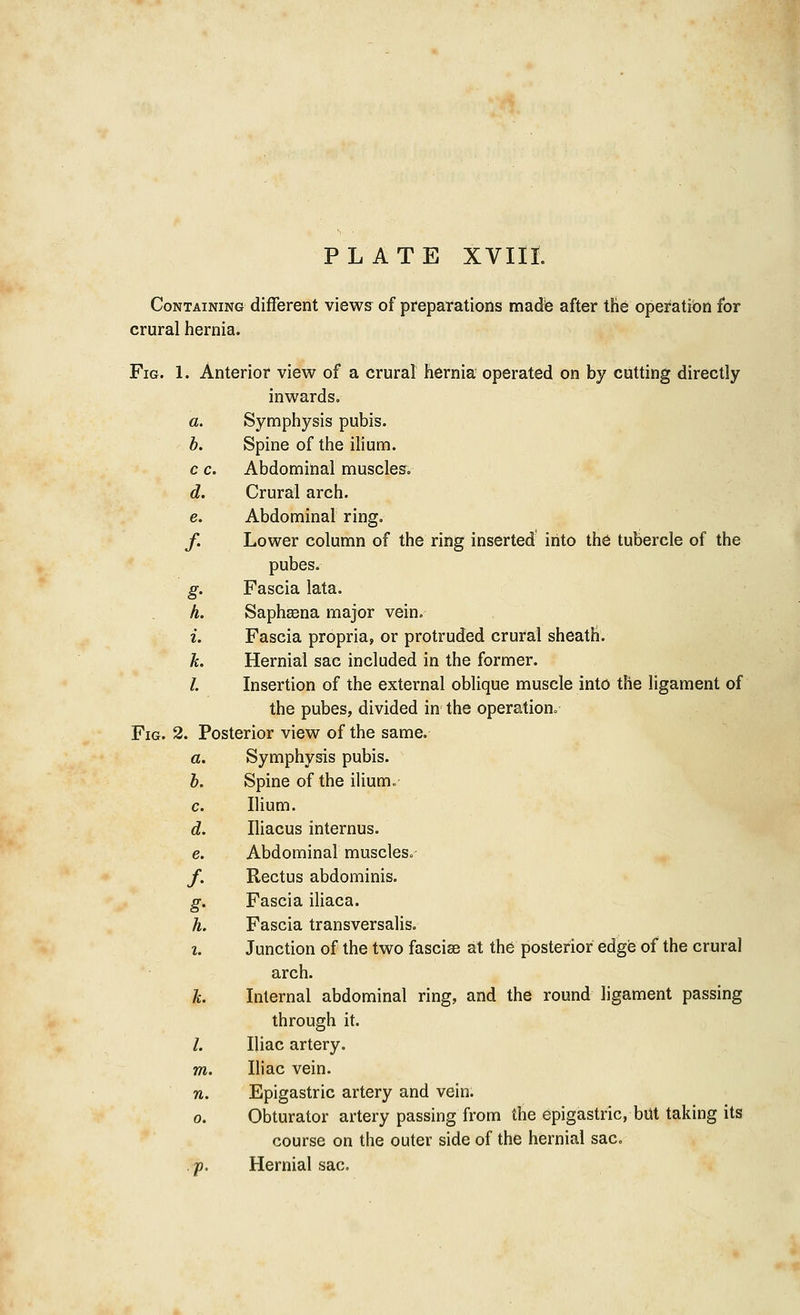 Containing different views of preparations made after the operation for crural hernia. Fig. 1. Anterior view of a crural hernia operated on by cutting directly inwards. a. Symphysis pubis. b. Spine of the ilium. c c. Abdominal muscles. d. Crural arch. e. Abdominal ring. /. Lower column of the ring inserted into the tubercle of the pubes. g. Fascia lata. h. Sapheena major vein. i. Fascia propria, or protruded crural sheatH. k. Hernial sac included in the former. /. Insertion of the external oblique muscle into the ligament of the pubes, divided in the operation. Fig. 2. Posterior view of the same. a. Symphysis pubis. b. Spine of the ilium. c. Ilium. d. Iliacus internus. e. Abdominal muscles. /. Rectus abdominis. g. Fascia iliaca. h. Fascia transversalis. i. Junction of the two fasciae at the posterior edge of the crural arch. h. Internal abdominal ring, and the round ligament passing through it. /. Iliac artery. m. Iliac vein. n. Epigastric artery and vein, o. Obturator artery passing from the epigastric, but taking its course on the outer side of the hernial sac. v. Hernial sac.
