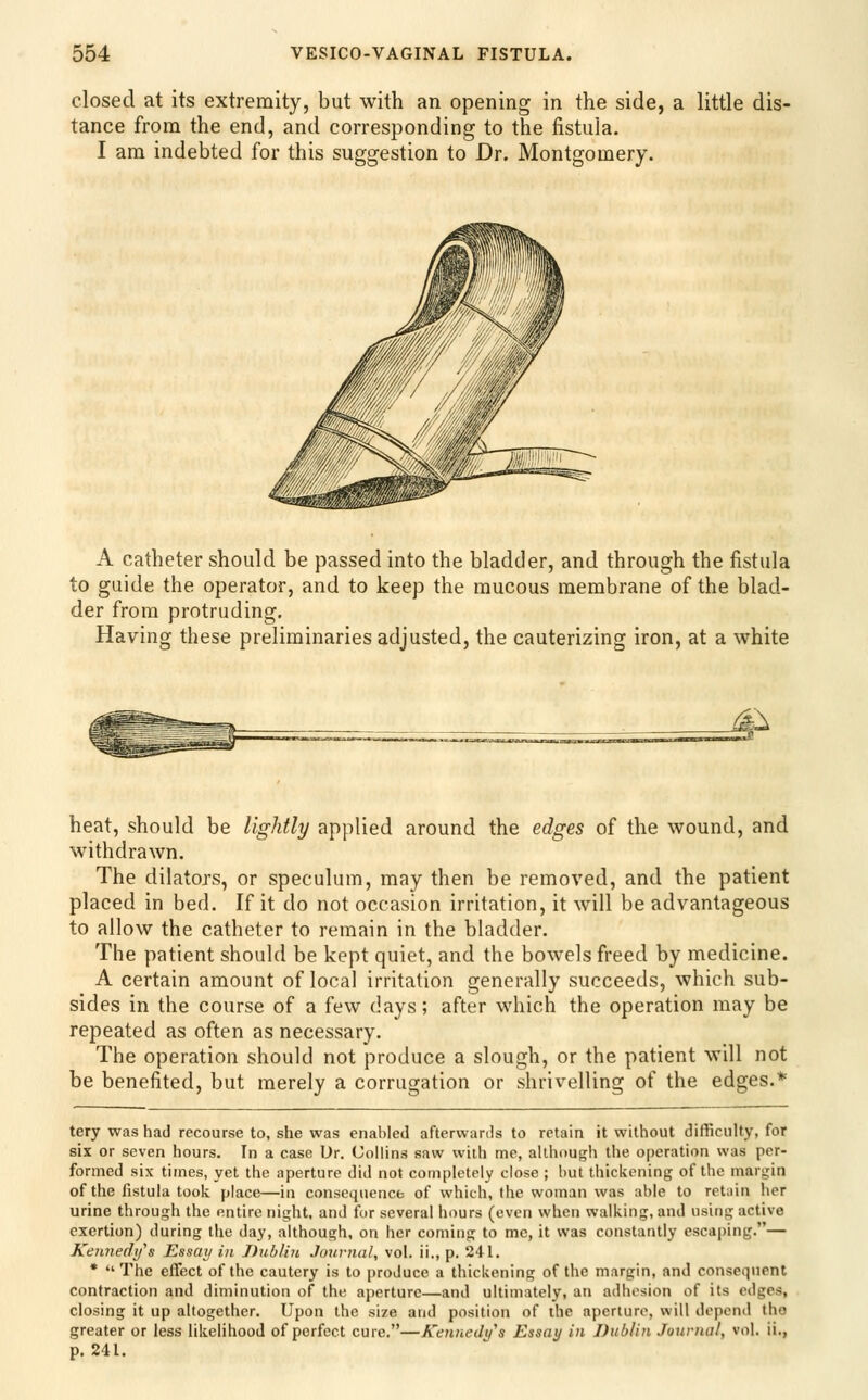 closed at its extremity, but with an opening in the side, a little dis- tance from the end, and corresponding to the fistula. I am indebted for this suggestion to Dr. Montgomery. A catheter should be passed into the bladder, and through the fistula to guide the operator, and to keep the mucous membrane of the blad- der from protruding. Having these preliminaries adjusted, the cauterizing iron, at a white M^ heat, should be lightly applied around the edges of the wound, and withdrawn. The dilators, or speculum, may then be removed, and the patient placed in bed. If it do not occasion irritation, it will be advantageous to allow the catheter to remain in the bladder. The patient should be kept quiet, and the bowels freed by medicine. A certain amount of local irritation generally succeeds, which sub- sides in the course of a few days; after which the operation may be repeated as often as necessary. The operation should not produce a slough, or the patient will not be benefited, but merely a corrugation or shrivelling of the edges.* tery was had recourse to, she was enabled afterwards to retain it without difficulty, for six or seven hours. In a case Dr. Collins saw with me, although the operation was per- formed six times, yet the aperture did not completely close ; hut thickening of the margin of the fistula took place—in consequence of which, the woman was able to ret;iin her urine through the entire night, and fur several hours (even when walking, and using active exertion) during the day, although, on her coming to me, it was constantly escaping.— Kennedy^s Essay in Ihiblin Journal, vol. ii., p. 241. * The effect of the cautery is to produce a thickening of the margin, and consequent contraction and diminution of the aperture—and ultimately, an adhesion of its edges, closing it up altogether. Upon the size and position of the aperture, will depend iho greater or less likelihood of perfect cure.—Kennedy s Essay in Dublin Journal, vol. ii., p. 241.