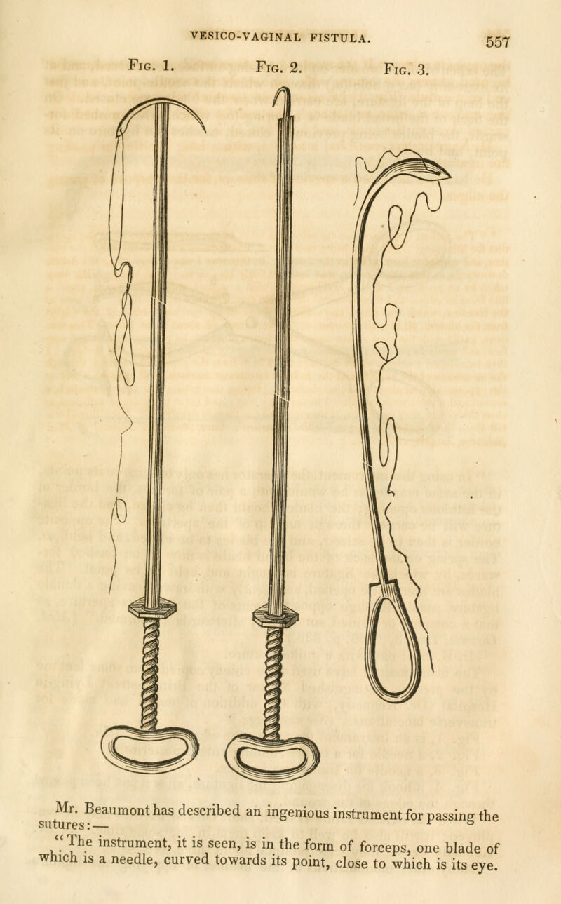 Fig. 1. Fig. 2. Fig. 3. 557 0 .\ Mr. Beaumont has described an ingenious instrument for passing the sutures:— ■^ ° The instrument, it is seen, is in the form of forceps, one blade of which IS a needle, curved towards its point, close to which is its eye.