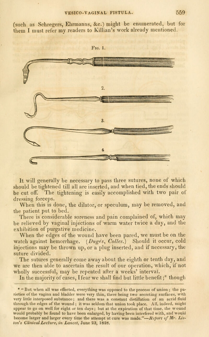 (such as Schregers, Ehrmanns, &c.) might be enumerated, but for them I must refer my readers to Killian's work ah'eady mentioned. Fig. 1. It will generally be necessary to pass three sutures, none of which should be tightened till all are inserted, and when tied, the ends should be cut off. The tightening is easily accomplished with two pair of dressing forceps. When this is done, the dilator, or speculum, may be removed, and the patient put to bed. There is considerable soreness and pain complained of, which may be relieved by vaginal injections of warm water twice a day, and the exhibition of purgative medicine. When the edges of the wound have been pared, we must be on the watch against hemorrhage. [Duges^ Colles.) Should it occur, cold injections may be thrown up, or a plug inserted, and if necessary, the suture divided. The sutures generally come away about the eighth or tenth day, and we are then able to ascertain the result of our operation, which, if not wholly successful, may be repeated after a weeks' interval. In the majority of cases, I fear we shall find but little benefit ;* though *  But when all was effected, everything was opposed to the process of union ; the pa- rieties of the vagina and bladder were very thin, there being two secreting surfaces, with very little interposed substance; and there was a constant distillation of an acrid fluid through the edges of the wound ; it was seldom that union took place. All, indeed, might appear to go on well for eight or ten days; but at the expiration of that time, the wound would probably be found to have been enlarged, by having been interfered with, and would become larger and larger every time the attempt at cure was made,—Report of Mr. Lis- ton's Clinical Lecture, in Lancet, June 23, 1828.