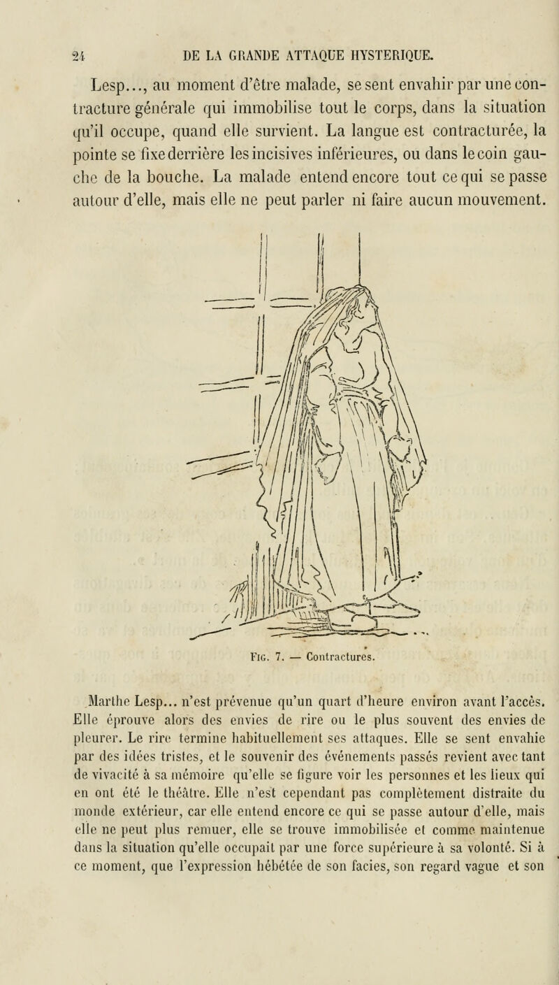 Lesp..., au moment d'être malade, se sent envahir par une con- tracture générale qui immobilise tout le corps, dans la situation qu'il occupe, quand elle survient. La langue est contracturée, la pointe se fixe derrière les incisives inférieures, ou dans le coin gau- che de la bouche. La malade entend encore tout ce qui se passe autour d'elle, mais elle ne peut parler ni faire aucun mouvement. FiG. 7. — Contractures. Marthe Lesp... n'est prévenue qu'un quart d'heure environ avant l'accès. Elle éprouve alors des envies de rire ou le plus souvent des envies de pleurer. Le rire termine habituellement ses attaques. Elle se sent envahie par des idées tristes, et le souvenir des événements passés revient avec tant de vivacité à sa mémoire qu'elle se figure voir les personnes et les lieux qui en ont été le théâtre. Elle n'est cependant pas complètement distraite du monde extérieur, car elle entend encore ce qui se passe autour d'elle, mais elle ne peut plus remuer, elle se trouve immobilisée et comme maintenue dans la situation qu'elle occupait par une force supérieure à sa volonté. Si à ce moment, que l'expression hébétée de son faciès, son regard vague et son