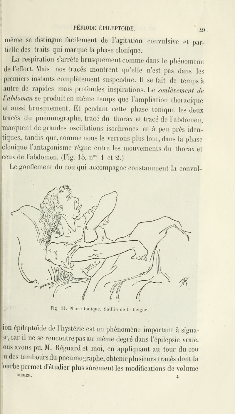 49 même se distingue facilement de l'agitation convulsive et par- tielle des traits qui marque la phase clonique. La respiration s'arrête brusquement comme dans le phénomène de l'eilfort. Mais nos tracés montrent qu'elle n'est pas dans les premiers instants complètement suspendue. Il se fait de temps à autre de rapides mais profondes inspirations. Le soulèvement de Vabdomen se produit en même temps que l'ampliation thoracique et aussi brusquement. Et pendant cette phase tonique les deux tracés du pneumographe, tracé du thorax et tracé de l'abdomen, marquent de grandes oscillations isochrones et à peu près iden- tiques, tandis que, comme nous le verrons plus loin, dans la phase clonique l'antagonisme règne entre les mouvements du thorax et ceux de l'abdomen. (Fig. d5, n**' \ et 2.) Le gonflement du cou qui accompagne constamment la convul- I... ' Fig 14. Phase tonique. Saillie de la lan.eur ion épileptoïde de l'hystérie est un phénomène important à signa- 3r,car il ne se rencontre pas au même degré dans l'épilepsie vraie, ous avons pu, M. Régnard et moi, en appliquant au tour du cou in des tambours du pneumographe, obtenirplusieurs tracés dont la ourbe permet d'étudier plus sûrement les modifications de volume RICHER.