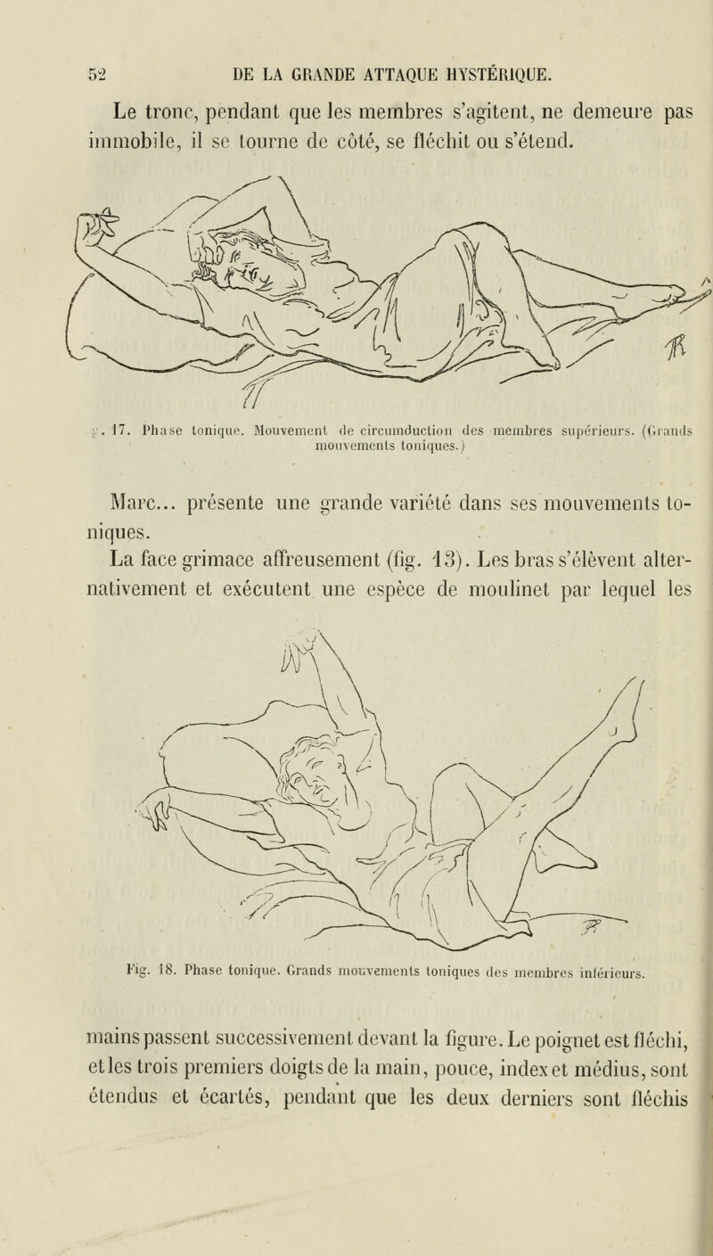 Le tronc, pendant que les membres s'agitent, ne demeure pas immobile, il se tourne de côté, se fléchit ou s'étend. 17. Phase tonique. Mouvement de circumduction des membres supérieurs. (Grands mouvements toniques.) Marc... présente une grande variété dans ses mouvements to- niques. La face grimace affreusement (fig. 13). Les bras s'élèvent alter- nativement et exécutent une espèce de moulinet par lequel les l'ig. 18. Phase tonique. Grands mov-vemcnts toniques des membres inférieurs mains passent successivement devant la figure. Le poignet est fléchi, etles trois premiers doigts de la main, pouce, index et médius, sont étendus et écartés, pendant que les deux derniers sont fléchis
