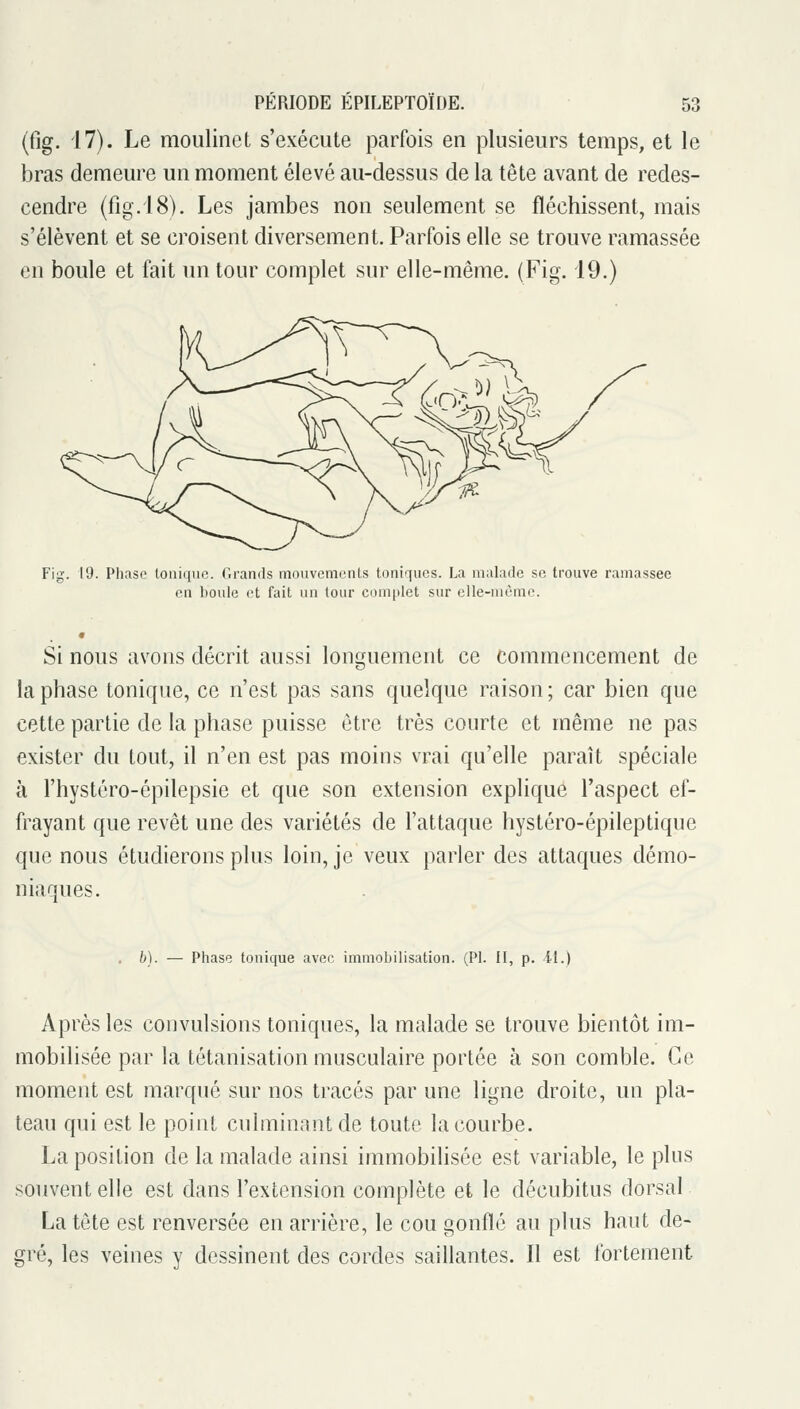 (fig. 17). Le moulinet s'exécute parfois en plusieurs temps, et le bras demeure un moment élevé au-dessus de la tête avant de redes- cendre (fig.iS). Les jambes non seulement se fléchissent, mais s'élèvent et se croisent diversement. Parfois elle se trouve ramassée en boule et fait un tour complet sur elle-même. (Fig. 19.) Fig. 19. Phase tonique. Grands mouvements toniques. La malade se trouve ramassée en boule et fait un tour complet sur elle-même. Si nous avons décrit aussi longuement ce commencement de la phase tonique, ce n'est pas sans quelque raison ; car bien que cette partie de la phase puisse être très courte et même ne pas exister du tout, il n'en est pas moins vrai qu'elle paraît spéciale à l'hystéro-épilepsie et que son extension explique l'aspect ef- frayant que revêt une des variétés de l'attaque hystéro-épileptique que nous étudierons plus loin, je veux parler des attaques démo- niaques. . b). — Phase tonique avec immobilisation. (PI. II, p. il.) Après les convulsions toniques, la malade se trouve bientôt im- mobilisée par la tétanisation musculaire portée à son comble. Ce moment est marqué sur nos tracés par une ligne droite, un pla- teau qui est le point culminant de toute la courbe. La position de la malade ainsi immobilisée est variable, le plus souvent elle est dans l'extension complète et le décubitus dorsal La tète est renversée en arrière, le cou gonflé au plus haut de- gré, les veines y dessinent des cordes saillantes. Il est fortement