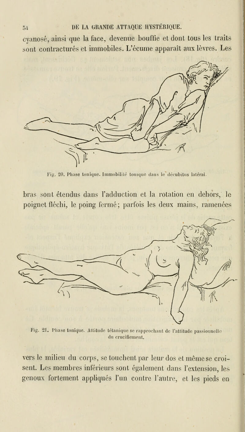 cyanose, ainsi que la face, devenue bouffie et dont tous les traits sont contractures et immobiles. L'écume apparaît aux lèvres. Les Fig. 20. Phase tonique. Immobilité tonique clans le décubitus laléral- bras sont étendus dans l'adduction et la rotation en dehors, le poignet fléchi, le poing fermé; parfois les deux mains, ramenées Fig. 21. Pliase tonique. Attitude tétanique se rapprochant do l'attitude passionnelle du crucifiement. vers le milieu du corps, se touchent par leur dos et même se croi- sent. Les membres inférieurs sont également dans l'extension, les genoux fortement appliqués l'un contre l'autre, et les pieds en