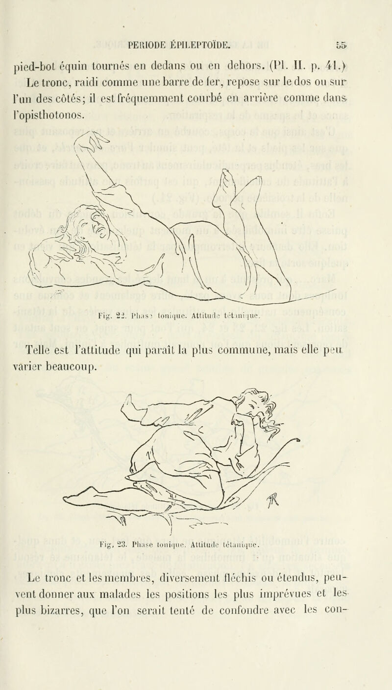 pied-bot équin tournés en dedans ou en dehors. (PI. II. p. 4L) Le tronc, raidi comme une barre de fer, repose sur le dos ou sur l'un des côtés; il est fréquemment courbé en arrière comme dans Topisthotonos. Fig. 22. IMiasî tonii(iic. AttiUulo trtiui lue. Telle est l'attitude qui paraît la plus commune, mais elle peu varier beaucoup. Fig, 53. Phase toniijuc Attitude lélaiiuiue. Le tronc et les membres, diversement fléchis ou étendus, peu- vent donner aux malades les positions les plus imprévues et les plus bizarres, que l'on serait tenté de confondre avec les con-