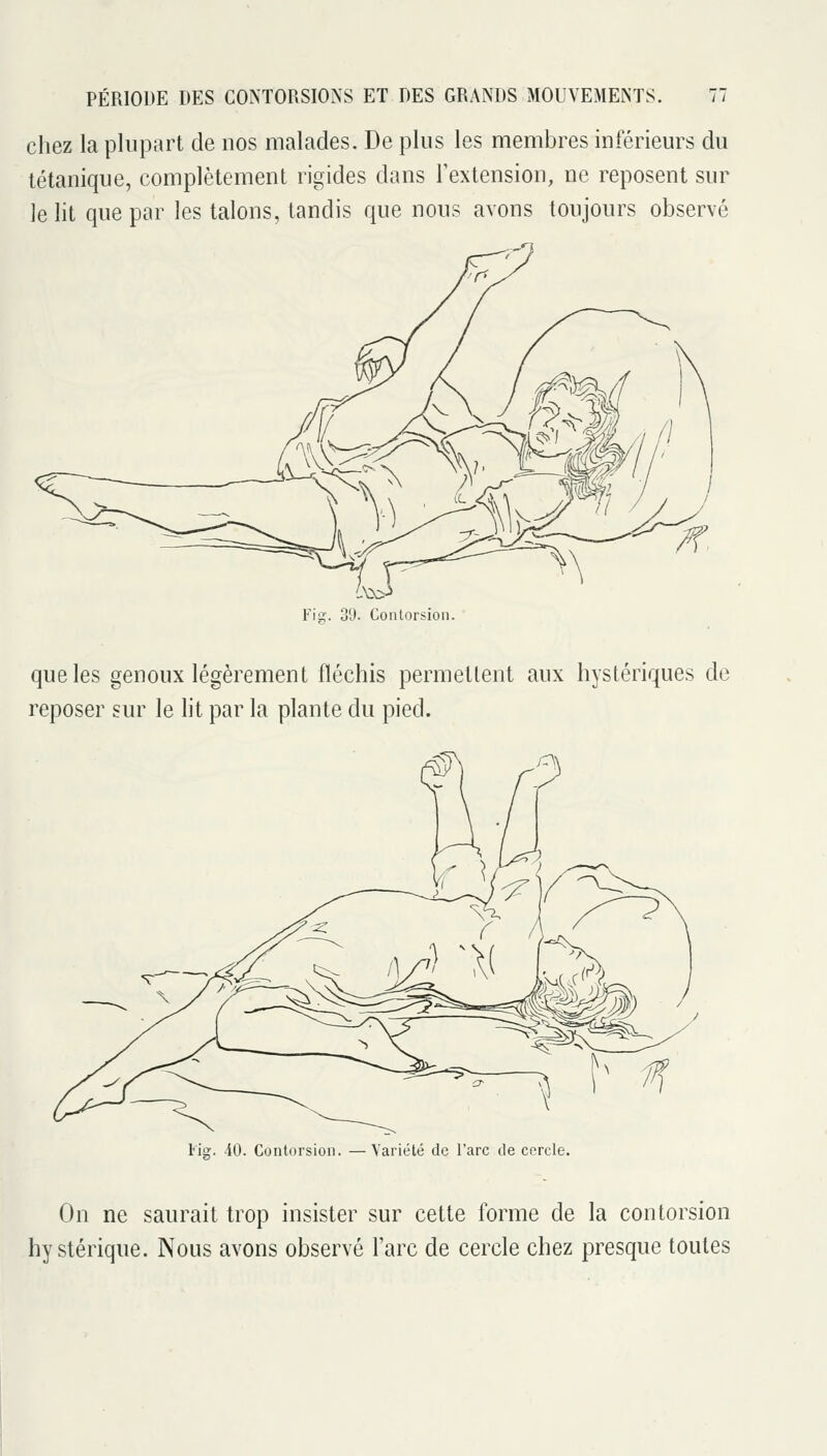 chez la plupart de nos malades. De plus les membres inférieurs du tétanique, complètement rigides dans l'extension, ne reposent sur le lit que par les talons, tandis que nous avons toujours observé Fis. 39. Contorsion. que les genoux légèrement fléchis permettent aux hystériques de reposer sur le lit par la plante du pied. Fis?. 40. Contorsion. —Variété de Tare de cercle. On ne saurait trop insister sur cette forme de la contorsion hystérique. Nous avons observé l'arc de cercle chez presque toutes