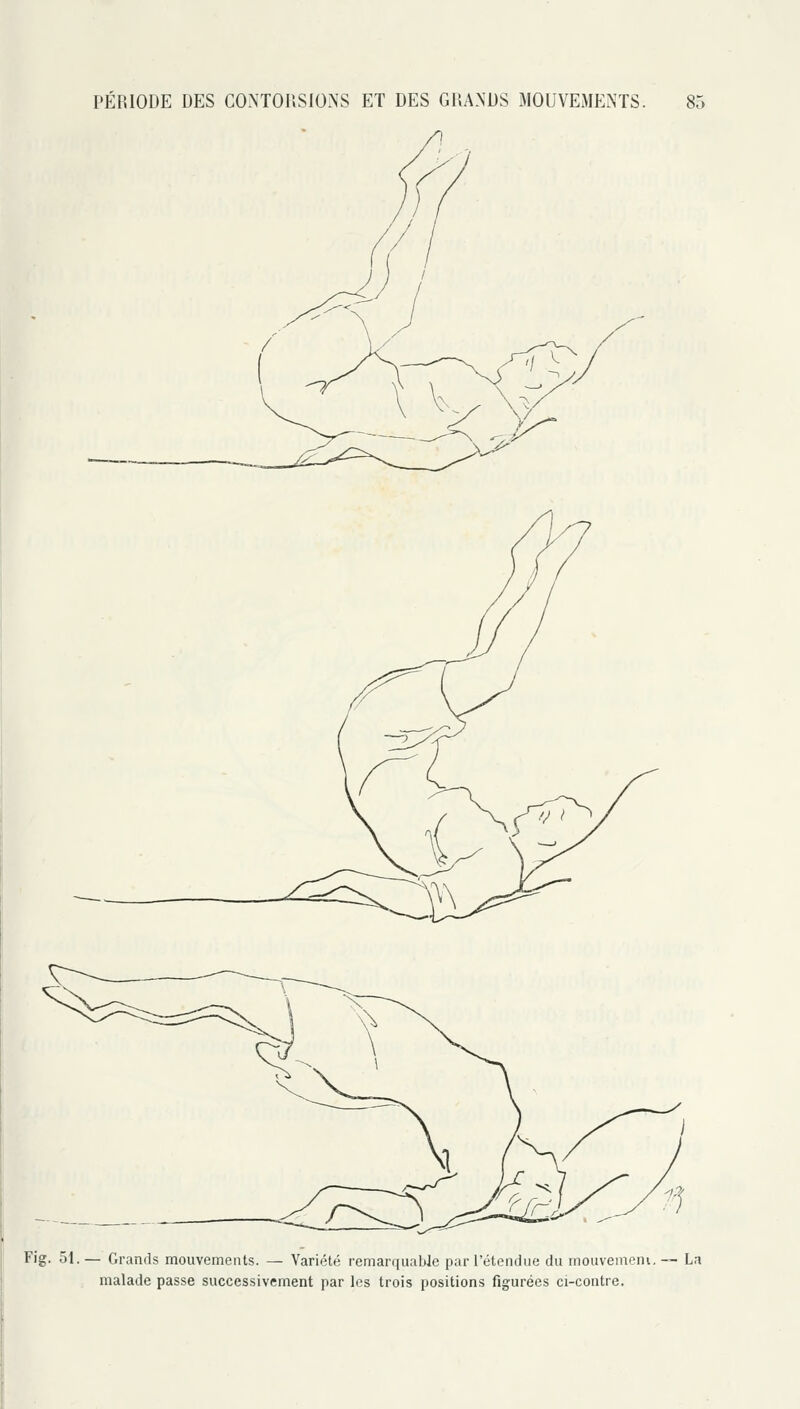 Fig. 51. — Grands mouvements. — Variété remarquable par l'étendue du mouvemeni. malade passe successivement par les trois positions figurées ci-contre. La