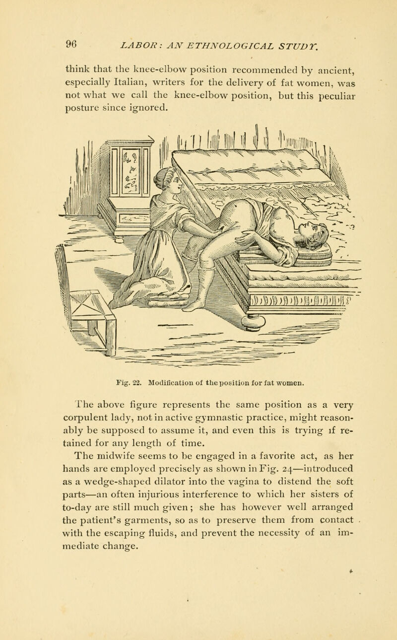 think that the knee-elbow position recommended by ancient, especially Italian, writers for the delivery of fat women, was not what we call the knee-elbow position, but this peculiar posture since ignored. Fig. 22. Modification of tlie position for fat women. The above figure represents the same position as a very corpulent lady, not in active gymnastic practice, might reason- ably be supposed to assume it, and even this is trying if re- tained for any length of time. The midwife seems to be engaged in a favorite act, as her hands are employed precisely as shown in Fig. 24—introduced as a wedge-shaped dilator into the vagina to distend the soft parts—an often injurious interference to which her sisters of to-day are still much given; she has however well arranged the patient's garments, so as to preserve them from contact with the escaping fluids, and prevent the necessity of an im- mediate change.