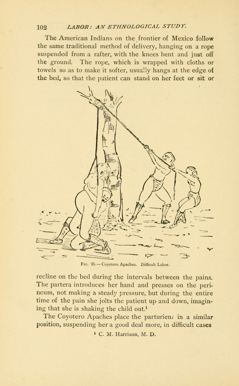 The American Indians on the frontier of Mexico follow the same traditional method of delivery, hanging on a rope suspended from a rafter, with the knees bent and just off the ground. The rope, which is wrapped with cloths or towels so as to make it softer, usually hangs at the edge of the bed, so that the patient can stand on her feet or sit or Fig. 25. —Coyotero Apaches. Difficult Labor. recline on the bed during the intervals between the pains. The partera introduces her hand and presses on the peri- neum, not making a steady pressure, but during the entire time of the pain she jolts the patient up and down, imagin- ing that she is shaking the child out.^ The Coyotero Apaches place the parturient in a similar position, suspending her a good deal more, in difficult cases 1 C. M. Harrison, M. D.