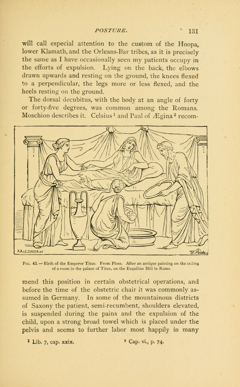 will call especial attention to the custom of the Hoopa, lower Klamath, and the Orleans-Bar tribes, as it is precisely the same as I have occasionally seen my patients occupy in the efforts of expulsion. Lying on the back, the elbows drawn upwards and resting on the ground, the knees flexed to a perpendicular, the legs more or less flexed, and the heels resting on the ground. The dorsal decubitus, with the body at an angle of forty or forty-five degrees, was common among the Romans, Moschion describes it. Celsius ^ and Paul of /Egina-^ recom- FiG. 42.— Birth of the Emperor Titus. From Ploss. After an antique painting on the ceiling of a room in the palace of Titus, on the Esquiline Hill in Rome. mend this position in certain obstetrical operations, and before the time of the obstetric chair it was commonly as- sumed in Germany. In some of the mountainous districts of Saxony the patient, semi-recumbent, shoulders elevated, is suspended during the pains and the expulsion of the child, upon a strong broad towel which is placed under the pelvis and seems to further labor most happily in many ^ Lib. 7, cap. xxix. a Cap. vi., p. 74.