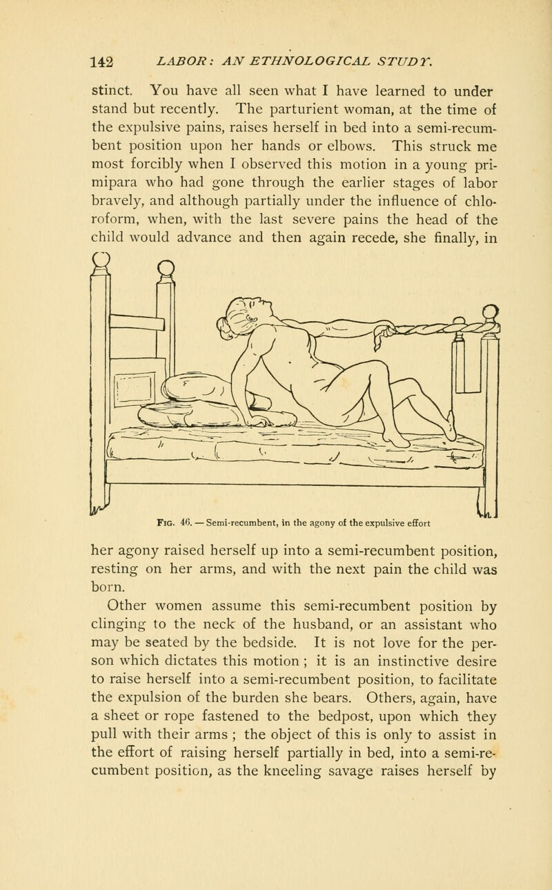 stinct. You have all seen what I have learned to under stand but recently. The parturient woman, at the time of the expulsive pains, raises herself in bed into a semi-recum- bent position upon her hands or elbows. This struck me most forcibly when I observed this motion in a young pri- mipara who had gone through the earlier stages of labor bravely, and although partially under the influence of chlo- roform, when, with the last severe pains the head of the child would advance and then again recede, she finally, in S a Fig. 46. — Semi-recumbent, in the agony of the expulsive effort her agony raised herself up into a semi-recumbent position, resting on her arms, and with the next pain the child was born. Other women assume this semi-recumbent position by clinging to the neck of the husband, or an assistant who may be seated by the bedside. It is not love for the per- son which dictates this motion ; it is an instinctive desire to raise herself into a semi-recumbent position, to facilitate the expulsion of the burden she bears. Others, again, have a sheet or rope fastened to the bedpost, upon which they pull with their arms ; the object of this is only to assist in the effort of raising herself partially in bed, into a semi-re- cumbent position, as the kneeling savage raises herself by