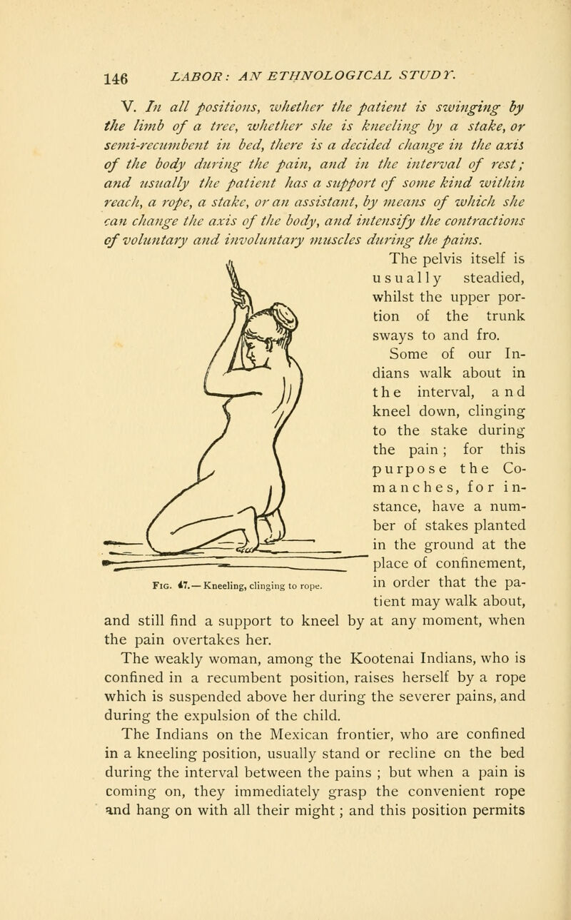 V. In all positions, zvhether the patient is swinging by the limb of a tree, wJiether she is kneeling by a stake, or semi-rectmibent in bed, there is a decided change in the axis of the body during the pain, and in the interval of rest; and nsjtally the patient has a stipport of some kind zvithin reach, a rope, a stake, or an assistant, by means of whicJi she can change the axis of the body, and intensify the contractions of voluntary and involuntary muscles during the patJis. The pelvis itself is usually steadied, whilst the upper por- tion of the trunk sways to and fro. Some of our In- dians walk about in the interval, and kneel down, clinging to the stake during the pain ; for this purpose the Co- ma nches, for in- stance, have a num- ber of stakes planted in the ground at the place of confinement, in order that the pa- tient may walk about, and still find a support to kneel by at any moment, when the pain overtakes her. The weakly woman, among the Kootenai Indians, who is confined in a recumbent position, raises herself by a rope which is suspended above her during the severer pains, and during the expulsion of the child. The Indians on the Mexican frontier, who are confined in a kneeling position, usually stand or recline en the bed during the interval between the pains ; but when a pain is coming on, they immediately grasp the convenient rope and hang on with all their might; and this position permits Fig. i7.— Kneeling, clinging to rope.