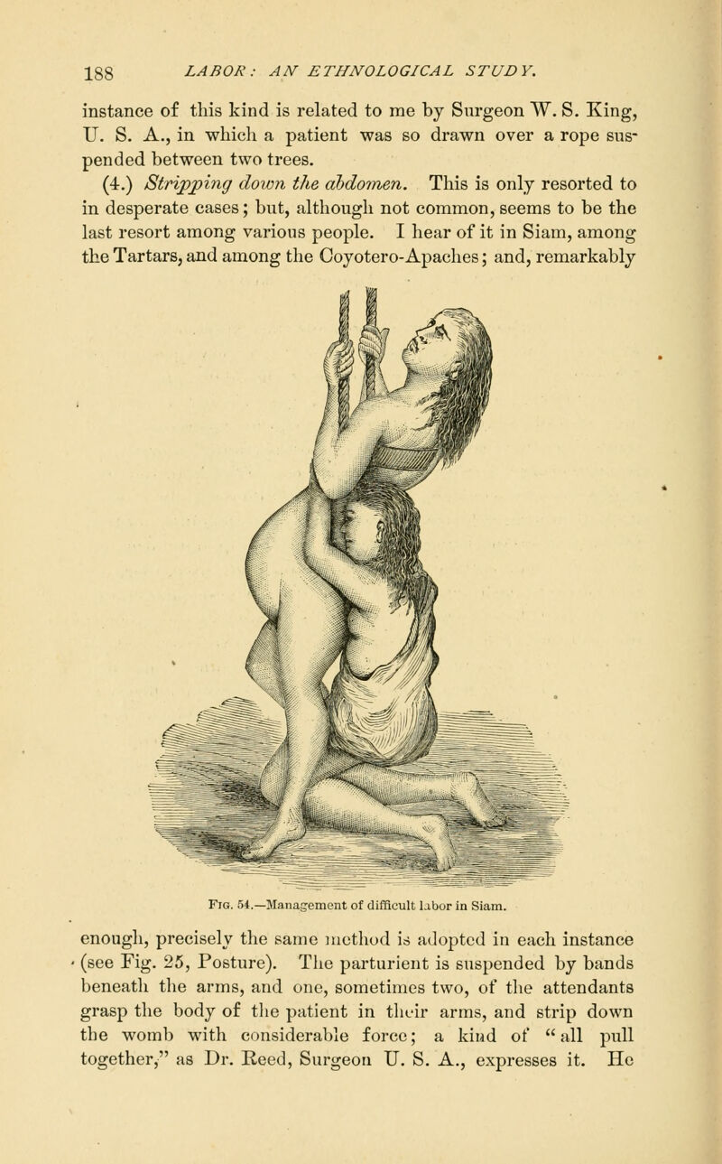 instance of this kind is related to me by Surgeon W. S. King, U. S. A., in which a patient was so drawn over a rope sus- pended between two trees. (4.) Stripping down the ahdotnen. This is only resorted to in desperate cases; but, although not common, seems to be the last resort among various people. I hear of it in Siam, among the Tartars, and among the Coyotero-Apaches; and, remarkably Fig. 54.—Management of difficult labor in Siam. enough, precisely the same method is adopted in each instance (see Fig. 25, Posture). The parturient is suspended by bands beneath the arms, and one, sometimes two, of tlie attendants grasp the body of the patient in their arms, and strip down the womb with considerable force; a kind of  all pull together, as Dr. Reed, Surgeon U. S. A., expresses it. He