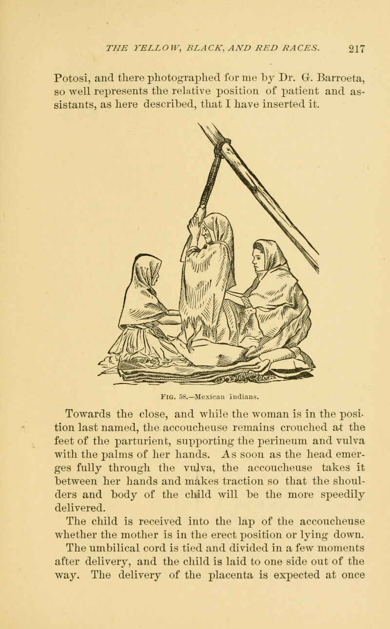 Potosi, and there photograplied for me by Dr. G. Barroeta, so well represents the relative position of patient and as- sistants, as here described, that I have inserted it. Fig. 58.—Mexican Indians. Towards the close, and while the woman is in the posi. tion last named, the accoucheuse remains crouched at the feet of the parturient, supporting the perineum and vulva with the palms of her hands. As soon as the head emer- ges fully through the vulva, the accoucheuse takes it between her hands and makes traction so that the shoul- ders and body of the child will be the more speedily delivered. The child is received into the lap of the accoucheuse whether the mother is in the erect position or lying down. The umbilical cord is tied and divided in a few moments after delivery, and the child is laid to one side out of the way. The delivery of the placenta is expected at once