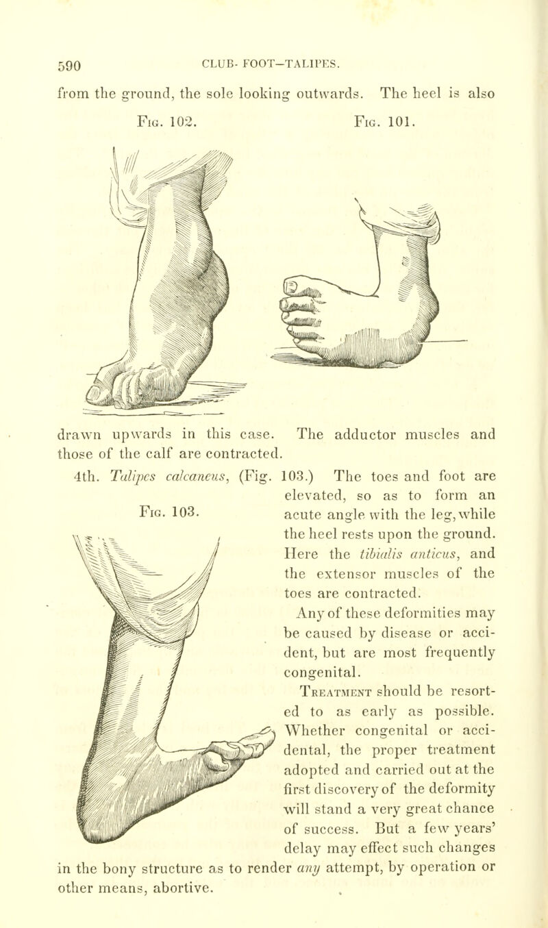 from the ground, the sole looking outwards. The heel is also Fig. 102. Fig. 101. drawn upwards in this case. The adductor muscles and those of the calf are contracted. 4th. Talipes calcaneus, (Fig. 103.) The toes and foot are elevated, so as to form an Fig. 103. acute angle with the leg, while the heel rests upon the ground. Here the tibialis anticiis, and the extensor muscles of the toes are contracted. Any of these deformities may be caused by disease or acci- dent, but are most frequently congenital. Treatment should be resort- ed to as early as possible. Whether congenital or acci- dental, the proper treatment adopted and carried out at the first discovery of the deformity will stand a very great chance of success. But a few years' delay may effect such changes in the bony structure as to render aiii/ attempt, by operation or other means, abortive.