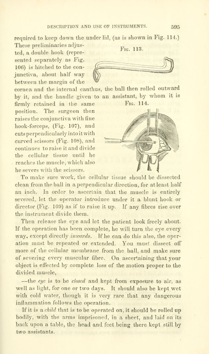 Fig. 113. required to keep down the under lid, (as is shown in Fig. 114.) These preliminaries adjus- ted, a double hook (repre- sented separately as Fig. 106) is hitched to the con- junctiva, about half way between the margin of the cornea and the internal canthus, the ball then rolled outward by it, and the handle given to an assistant, by whom it is firmly retained in the same Fig. 114. position. The surgeon then raises the conjunctiva with fine hook-forceps, (Fig. 107), and cuts perpendicularly into it with curved scissors (Fig. 108), and continues to raise it and divide the cellular tissue until he reaches the muscle, which also he severs with the scissors. To make sure work, the cellular tissue should be dissected clean from the ball in a perpendicular direction, for at least half an inch. In order to ascertain that the muscle is entirely severed, let the operator introduce under it a blunt hook or director (Fig. 109) as if to raise it up. If any fibres rise over the instrument divide them. Then release the eye and let the patient look freely about. If the operation has been complete, he will turn the eye every way, except directly inwards. If he can do this also, the oper- ation must be repeated or extended. You must dissect off more of the cellular membrane from the ball, and make sure of severing every muscular fibre. On ascertaining that your object is effected by complete loss of the motion proper to the divided muscle, —the eye is to be closed and kept from exposure to air, as well as light, for one or two days. It should also be kept wet with cold water, though it is very rare that any dangerous inflammation follows the operation. If it is a child that is to be operated on, it should be rolled up bodily, with the arms imprisoned, in a sheet, and laid on its back upon a table, the head and feet being there kept still by two assistants.
