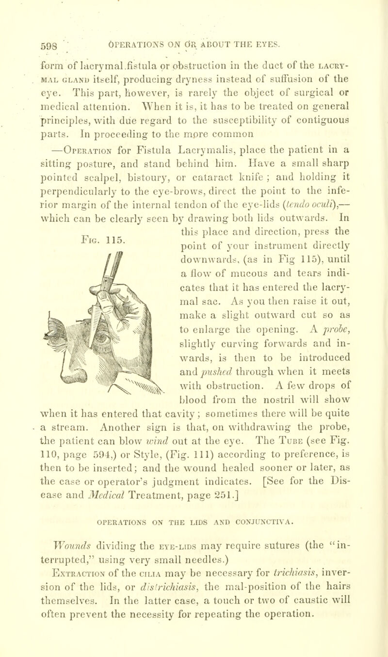 Fig. 115. form of lacrymal.fistula or obstruction in the duct of the lacry- MAL GLAND itsclf, producing dryness instead of suffusion of the eye. This part, however, is rarely the object of surgical or medical attention. When it is, it has to be treated on general principles, with due regard to the susceptibility of contiguous parts. In proceeding to the mpre common —Operation for Fistula Lacrymalis, place the patient in a sitting posture, and stand behind him. Have a small sharp pointed scalpel, bistoury, or cataract knife ; and holding it perpendicularly to the eye-brows, direct the point to the infe- rior margin of the internal tendon of the eye-lids (Undo ocuU),— which can be clearly seen by drawing both lids outwards. In this place and direction, press the point of your instrument directly downwards, (as in Fig 115), until a flow of mucous and tears indi- cates that it has entered the lacry- mal sac. As you then raise it out, make a slight outward cut so as to enlarge the opening. A probe, slightly curving forwards and in- wards, is then to be introduced and pushed through when it meets with obstruction. A few drops of l)lood from the nostril will show when it has entered that cavity; sometimes there will be quite a stream. Another sign is that, on withdrawing the probe, the patient can blow ivind out at the eye. The Tube (see Fig. 110, page 594,) or Style, (Fig. HI) according to preference, is then to be inserted; and the wound healed sooner or later, as the case or operators judgment indicates. [See for the Dis- ease and Medical Treatment, page 251.] OPERATIONS ON THE LIDS AND CONJUNCTIVA. Wounds dividing the eye-lids may require sutures (the in- terrupted, using very small needles.) Extraction of the cilia may be necessary for iricliiasis, inver- sion of the lids, or dis'richiasis, the mal-position of the hairs themselves. In the latter case, a touch or two of caustic will often prevent the necessity for repeating the operation.
