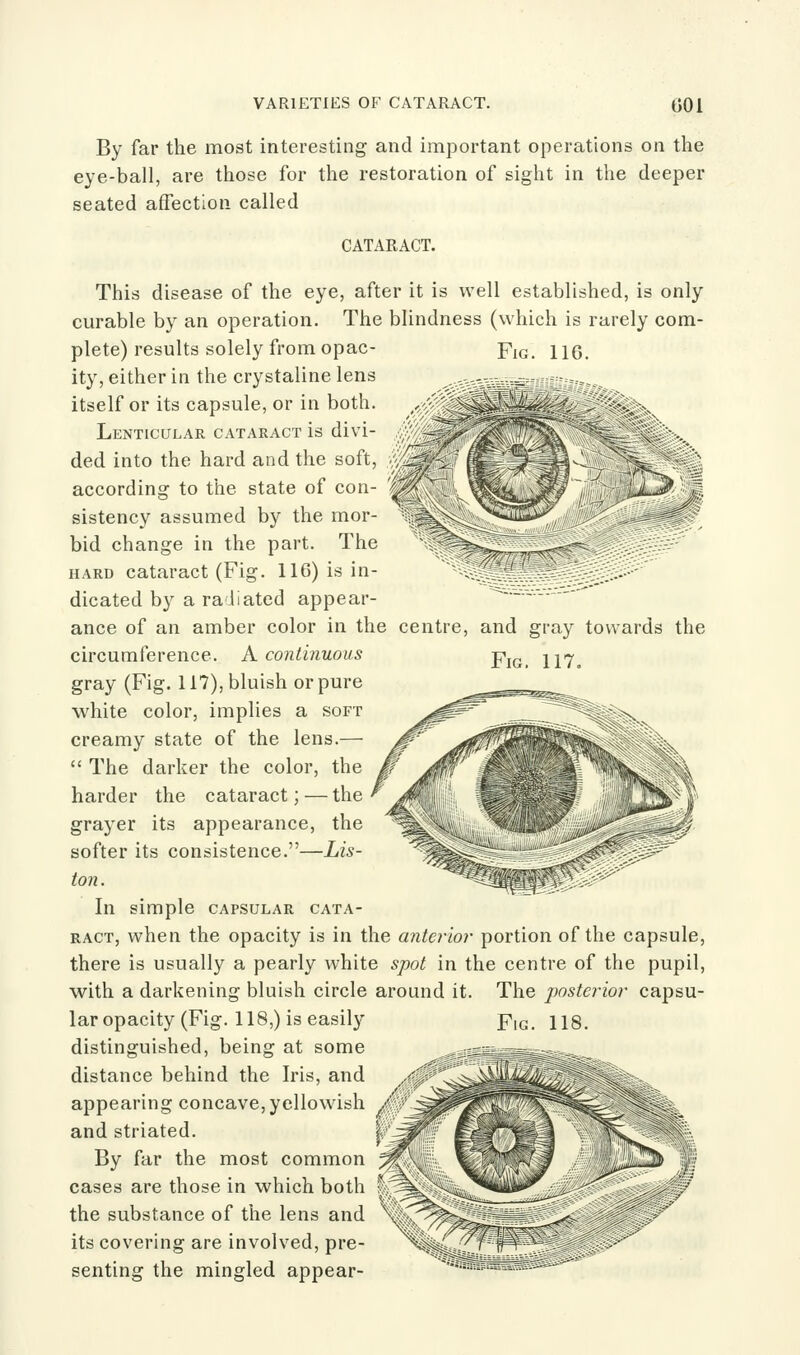 VARIETIES OF CATARACT. 001 By far the most interesting and imjiortant operations on the eye-ball, are those for the restoration of sight in the deeper seated affection called CATARACT. This disease of the eye, after it is well established, is only curable by an operation. The blindness (which is rarely com- plete) results solely from opac- Yig. 116. ity, either in the crystaline lens itself or its capsule, or in both. Lenticular cataract is divi- ded into the hard and the soft, according to the state of con- /^ sistency assumed by the mor- bid change in the part. The HARD cataract (Fig. 116) is in- --.--..-....-.^.--.- .-^ dicated by a radiated appear- -—-.--•.--- ance of an amber color in the centre, and gray towards the Fig. 117, circumference. A continuous gray (Fig. 117), bluish or pure white color, implies a soft creamy state of the lens.—  The darker the color, the harder the cataract; — the grayer its appearance, the softer its consistence.—Lis- ton. In simple capsular cata- ract, when the opacity is in the anterior portion of the capsule, there is usually a pearly white spot in the centre of the pupil, with a darkening bluish circle around it. The posterior capsu- lar opacity (Fig. 118,) is easily distinguished, being at some distance behind the Iris, and appearing concave, yellowish / and striated. By far the most common cases are those in which both the substance of the lens and its covering are involved, pre- senting the mingled appear- FiG. 118.