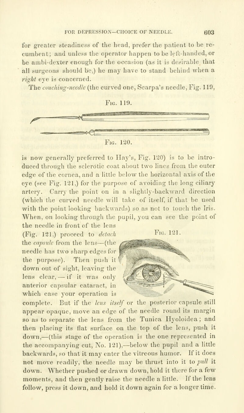 for greater steadiness of the head, prefer the patient to be re- cumbent; and unless the operator happen to be left-handed, or be ambi-dexter enough for the occasion (as it is desirable that all surgeons should be,) he may have to stand behind when a I'ight eye is concerned. The couching-nccdlc (the curved one, Scarpa's needle, Fig. 119, Fig. 119. Fig. 120. is now generally preferred to Hay's, Fig. 120) is to be intro- duced through the sclerotic coat about two lines from the outer edge of the cornea, and a little below the horizontal axis of the eye (see Fig. 121,) for the purpose of avoiding the long ciliary artery. Carry the point on in a slightly-backward direction (which the curved needle will take of itself, if that be used with the point looking backwards) so as not to touch the Iris. When, on looking through the pupil, you can see the point of the needle in front of the lens (Fig. 121,) proceed to detach ^^^- 121. the capsule from the lens—(the needle has two sharp edges for the purpose). Then push it down out of sight, leaving the lens clear, — if it was only anterior capsular cataract, in which case your operation is complete. But if the lens itself or the posterior capsule still appear opaque, move an edge of the needle round its margin so as to separate the lens from the Tunica Hyoloidea; and then placing its flat surface on the top of the lens, push it down,—(this stage of the operation is the one represented in the accompanying cut, No. 121),—below the pupil and a little backwards, so that it may enter the vitreous humor. If it does not move readily, the needle may be thrust into it io pull it down. Whether pushed or drawn dow^n, hold it there for a few moments, and then gently raise the needle a little. If the lens follow, press it down, and hold it down again for a longer time.