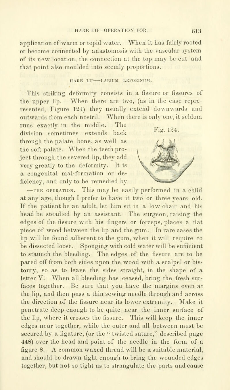 application of warm or tepid water. When it has fairly rooted or become connected by anastomosis with the vascular system of its new location, the connection at the top may be cut and that point also moulded into seemly proportions. HARE LIP LABIUM LEPORINUM. This striking deformity consists in a fissure or fissures of the upper lip. When there are two, (as in the case repre- resented. Figure 124) they usually extend downwards and outwards from each nostril. When there is only one, it seldom runs exactly in the middle. The division sometimes extends back through the palate bone, as well as the soft palate. When the teeth pro- ject through the severed lip, they add very greatly to the deformity. It is a congenital mal-formation or de- ficiency, and only to be remedied by —THE OPERATION. This may be easily performed in a child at any age, though I prefer to have it two or three years old. If the patient be an adult, let him sit in a low chair and his head be steadied by an assistant. The surgeon, raising the edges of the fissure with his fingers or forceps, places a flat piece of wood between the lip and the gum. In rare cases the lip will be found adherent to the gum, when it will require to be dissected loose. Sponging with cold water will be suflicient to staunch the bleeding. The edges of the fissure are to be pared off from both sides upon the wood with a scalpel or bis- toury, so as to leave the sides straight, in the shape of a letter V. When all bleeding has ceased, bring the fresh sur- faces together. Be sure that you have the margins even at the lip, and then pass a thin sewing needle through and across the direction of the fissure near its lovver extremity. Make it penetrate deep enough to be quite near the inner surface of the lip, where it crosses the fissure. This will keep the inner edges near together, while the outer and all between must be secured by a ligature, (or the  twisted suture, described page 448) over the head and point of the needle in the form of a figure 8. A common waxed thread will be a suitable material, and should be drawn tight enough to bring the wounded edges together, but not so tight as to strangulate the parts and cause