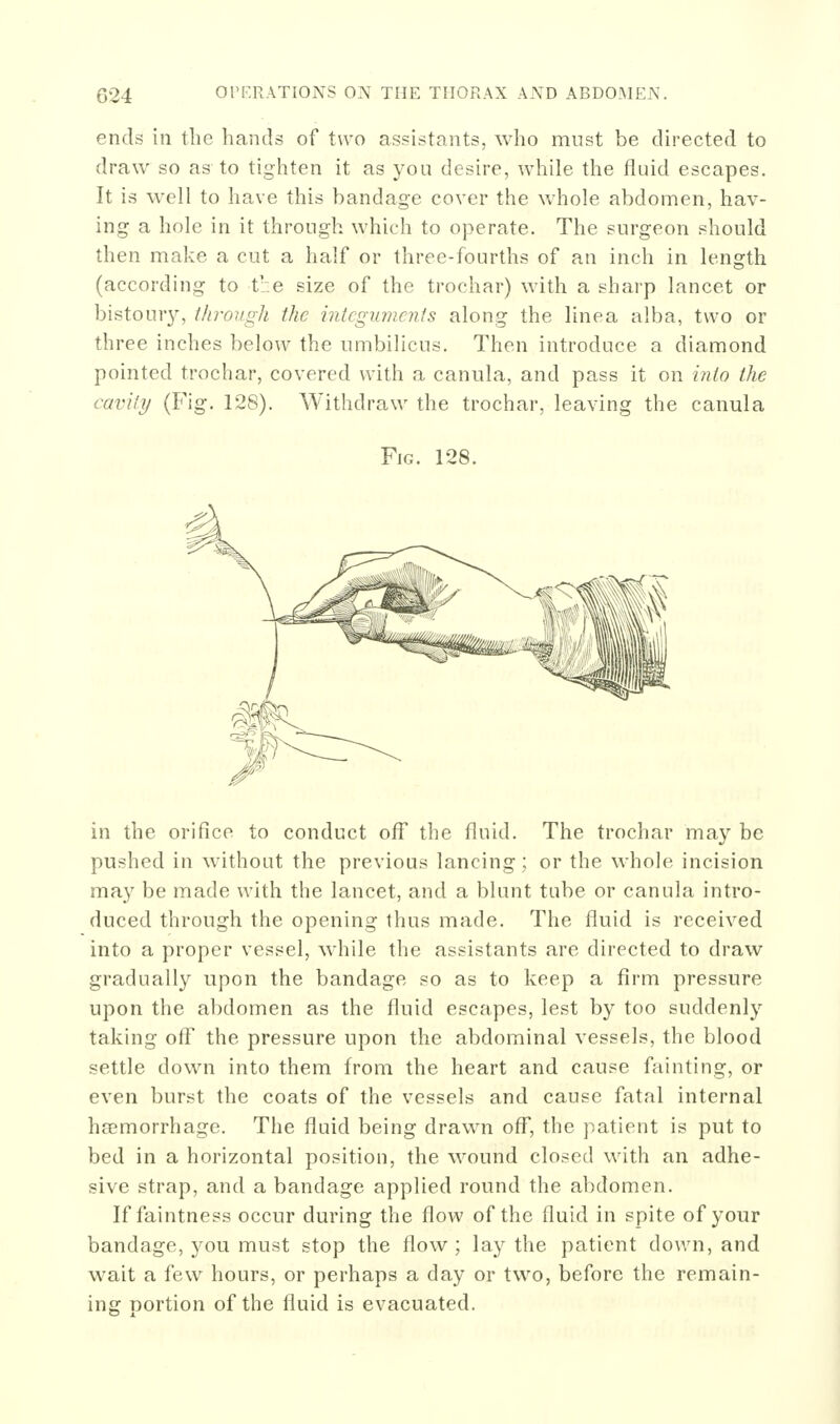 ends in the hands of two assistants, who must be directed to draw so as to tighten it as you desire, while the fluid escapes. It is well to have this bandage cover the whole abdomen, hav- ing a hole in it through which to operate. The surgeon should then make a cut a half or three-fourths of an inch in length (according to tr.e size of the trochar) with a sharp lancet or bistoury, througli the intcgiancnts along the linea alba, two or three inches below the umbilicus. Then introduce a diamond pointed trochar, covered with a canula, and pass it on into the cavity (Fig. 128). Withdraw the trochar, leaving the canula Fig. 128. in the orifice to conduct off the fluid. The trochar may be pushed in without the previous lancing; or the whole incision may be made with the lancet, and a blunt tube or canula intro- duced through the opening thus made. The fluid is received into a proper vessel, while the assistants are directed to draw gradually upon the bandage so as to keep a firm pressure upon the abdomen as the fluid escapes, lest by too suddenly taking off the pressure upon the abdominal vessels, the blood settle down into them from the heart and cause fainting, or even burst the coats of the vessels and cause fatal internal haemorrhage. The fluid being drawn off, the patient is put to bed in a horizontal position, the wound closed with an adhe- sive strap, and a bandage applied round the abdomen. If faintness occur during the flow of the fluid in spite of your bandage, you must stop the flow ; lay the patient down, and wait a few hours, or perhaps a day or two, before the remain- ing: Dortion of the fluid is evacuated.