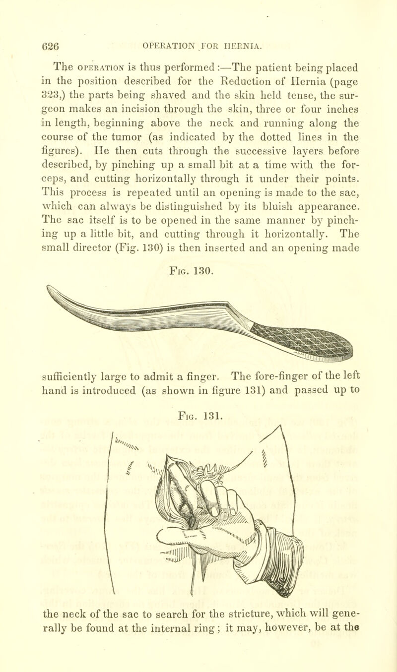 The OPERATION is thus performed :—The patient being placed in the position described for the Reduction of Hernia (page 323,) the parts being shaved and the skin held tense, the sur- geon makes an incision through the skin, three or four inches in length, beginning above the neck and running along the course of the tumor (as indicated by the dotted lines in the figures). He then cuts through the successive layers before described, by pinching up a small bit at a time with the for- ceps, and cutting horizontally through it under their points. This process is repeated until an opening is made to the sac, which can always be distinguished by its bluish appearance. The sac itself is to be opened in the same manner by pinch- ing up a little bit, and cutting through it horizontally. The small director (Fig. 130) is then inserted and an opening made Fig. 130. sufficiently large to admit a finger. The fore-finger of the left hand is introduced (as shown in figure 131) and passed up to Fig. 131. 'i^xv X\N the neck of the sac to search for the stricture, which will gene- rally be found at the internal ring; it may, however, be at the