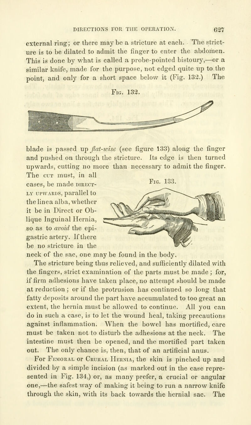 external ring; or there maybe a stricture at each. The strict- ure is to be dilated to admit the finger to enter the abdomen. This is done by what is called a probe-pointed bistoury,—or a similar knife, made for the purpose, not edged quite up to the point, and only for a short space below it (Fig. 132.) The Fig. 132. blade is passed up Jiat-ivise (see figure 133) along the finger and pushed on through the stricture. Its edge is then turned upwards, cutting no more than necessary to admit the finger. The CUT must, in all cases, be made direct- LY UPWARDS, parallel to the line a alba, whether it be in Direct or Ob- lique Inguinal Hernia, so as to avoid the epi- gastric artery. If there be no stricture in the neck of the sac, one may be found in the body. The stricture being thus relieved, and sufficiently dilated with the fingers, strict examination of the parts must be made ; for, if firm adhesions have taken place, no attempt should be made at reduction; or if the protrusion has continued so long that fatty deposits around the part have accumulated to too great an extent, the hernia must be allowed to continue. All you can do in such a case, is to let the wound heal, taking precautions against inflammation. When the bowel has mortified, care must be taken not to disturb the adhesions at the neck. The intestine must then be opened, and the mortified part taken out. The only chance is, then, that of an artificial anus. For Femoral or Crural Hernia, the skin is pinched up and divided by a simple incision (as marked out in the case repre- sented in Fig. 134,) or, as many prefer, a crucial or angular one,—the safest way of making it being to run a narrow knife through the skin, with its back towards the hernial sac. The