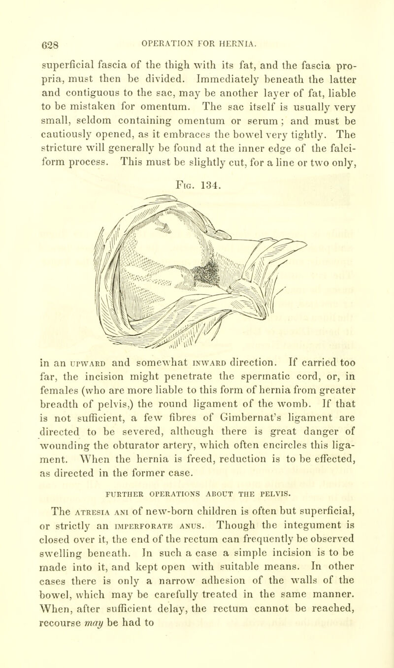 superficial fascia of tlie thigh with its fat, and the fascia pro- pria, must then be divided. Immediately beneath the latter and contiguous to the sac, may be another layer of fat, liable to be mistaken for omentum. The sac itself is usually very small, seldom containing omentum or serum ; and must be cautiously opened, as it embraces the bowel very tightly. The stricture will generally be found at the inner edge of the falci- form process. This must be slightly cut, for a line or two only, Fig. 134. in an upward and somewhat inward direction. If carried too far, the incision might penetrate the spermatic cord, or, in females (who are more liable to this form of hernia from greater breadth of pelvis,) the round ligament of the womb. If that is not sufficient, a few fibres of Gimbernat's ligament are directed to be severed, although there is great danger of wounding the obturator artery, which often encircles this liga- ment. When the hernia is freed, reduction is to be effected, as directed in the former case. FURTHER OPERATIONS ABOUT THE PELVIS. The ATRESIA ANi of ncw-bom children is often but superficial, or strictly an imperforate anus. Though the integument is closed over it, the end of the rectum can frequently be observed swelling beneath. In such a case a simple incision is to be made into it, and kept open with suitable means. In other cases there is only a narrow adhesion of the walls of the bowel, which may be carefully treated in the same manner. When, after sufficient delay, the rectum cannot be reached, recourse may be had to