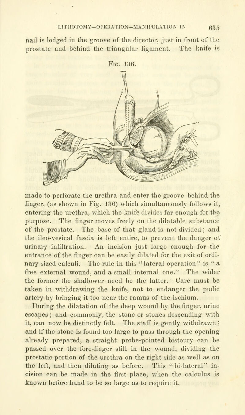 nail is lodged in the groove of the director, just in front of the prostate and behind the triangular ligament. The knife is Fig. 136. made to perforate the urethra and enter the groove behind the finger, (as shown in Fig. 136) which simultaneously follows it, entering the urethra, which the knife divides far enough for tb« purpose. The finger moves freely on the dilatable substance of the prostate. The base of that gland is not divided ; and the ileo-vesical fascia is left entire, to prevent the danger of urinary infiltration. An incision just large enough for the entrance of the finger can be easily dilated for the exit of ordi- nary sized calculi. The rule in this lateral operation is a free external wound, and a small internal one. The wider the former the shallower need be the latter. Care must be taken in withdrawing the knife, not to endanger the pudic artery by bringing it too near the ramus of the ischium. During the dilatation of the deep wound by the finger, urine escapes ; and commonly, the stone or stones descending with it, can now be distinctly felt. The staff' is gently withdrawn; and if the stone is found too large to pass through the opening already prepared, a straight probe-pointed bistoury can be passed over the fore-finger still in the wound, dividing the prostatic portion of the urethra on the right side as well as on the left, and then dilating as before. This bi-lateral in- cision can be made in the first place, when the calculus is known before hand to be so large as to require it.