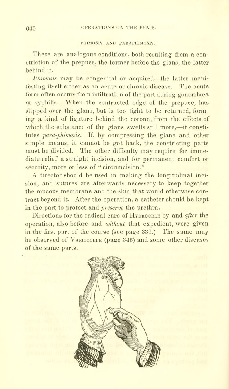 PHIMOSIS AND PARAPHIMOSIS. These are analogous conditions, both resulting from a con- striction of the prepuce, the former before the glans, the latter behind it. Phunosis may be congenital or acquired—the latter mani- lesting itself either as an acute or chronic disease. The acute form often occurs from infiltration of the part during gonorrhoea or syphilis. When the contracted edge of the prepuce, has slipped over the glans, but is too tight to be returned, form- ing a kind of ligature behind the corona, from the eflects of which the substance of the glans swells still more,—it consti- tutes para-phimosis. If, by compressing the glans and other simple means, it cannot be got back, the constricting parts must be divided. The other difficulty may require for imme- diate relief a straight incision, and for permanent comfort or security, more or less of circumcision. A director should be used in making the longitudinal inci- sion, and sutures are afterwards necessary to keep together the mucous membrane and the skin that would otherwise con- tract beyond it. After the operation, a catheter should be kept in the part to protect and preserve the urethra. Directions for the radical cure of Hydrocele by and after the operation, also before and ivitliout that expedient, were given in the first part of the course (see page 339.) The same may be observed of Varicocele (page 340) and some other diseases of the same parts.