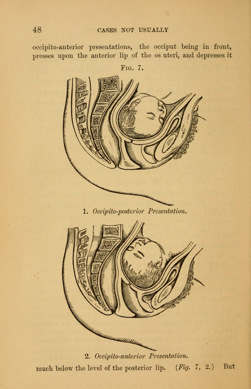 •occipito-anterior presentations, the occiput being in front, jiresses upon the anterior lip of the os uteri, and depresses it Fig. 7. 2. Occipito-anterior Presentation. much below the level of the posterior lip. {Fig. 7, 2.) But