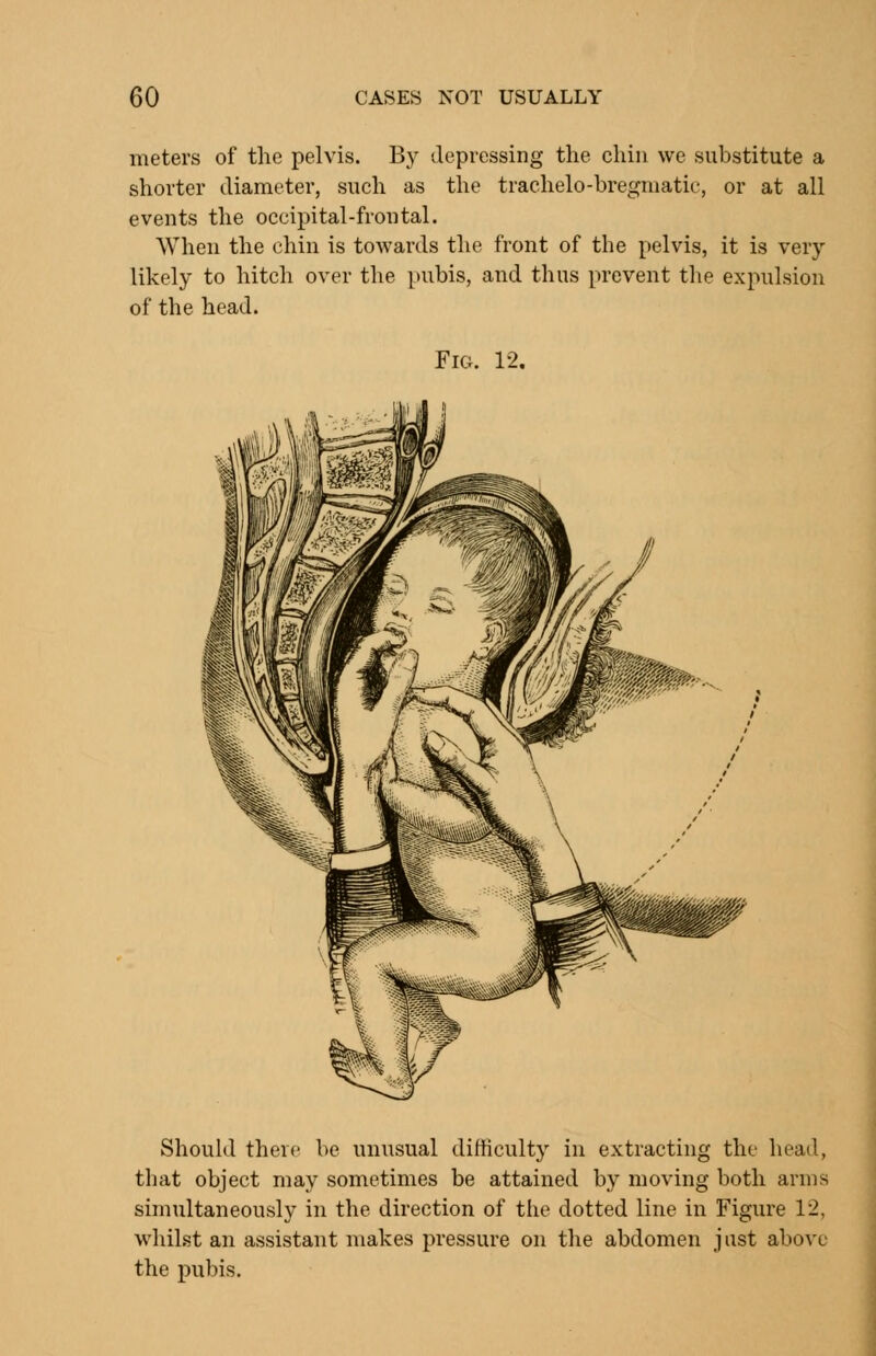meters of the pelvis. By depressing the chin we substitute a shorter diameter, such as the trachelo-bregniatie, or at all events the occipital-frontal. When the chin is towards the front of the pelvis, it is very- likely to hitch over the pubis, and thus prevent the expulsion of the head. Fig. 12. Should there be unusual difficulty in extracting the head, that object may sometimes be attained by moving both arms simultaneously in the direction of the dotted line in Figure 12, whihst an assistant makes pressure on the abdomen just above the pubis.
